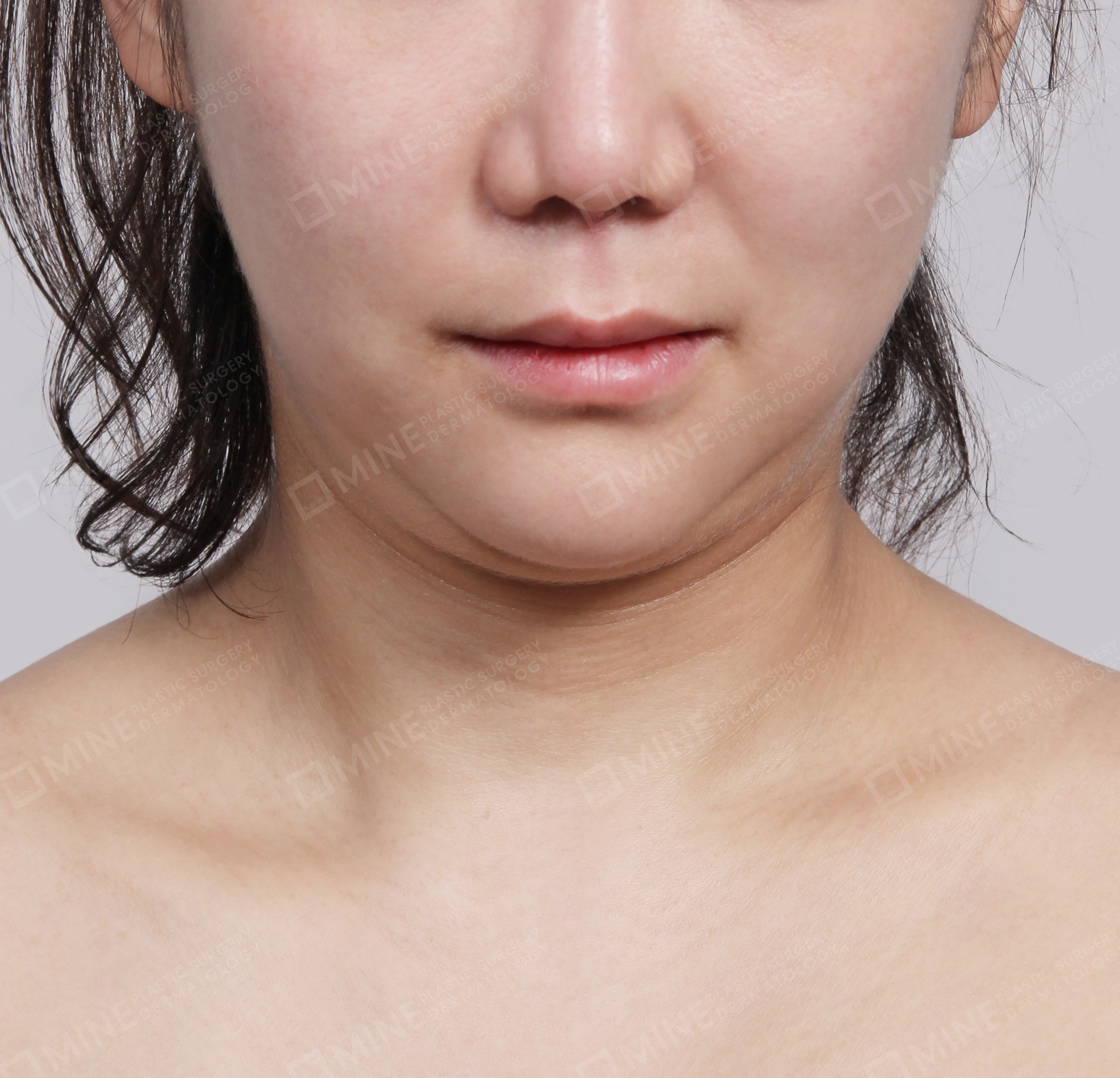 Double Chin (Vlimming)-Front-Before