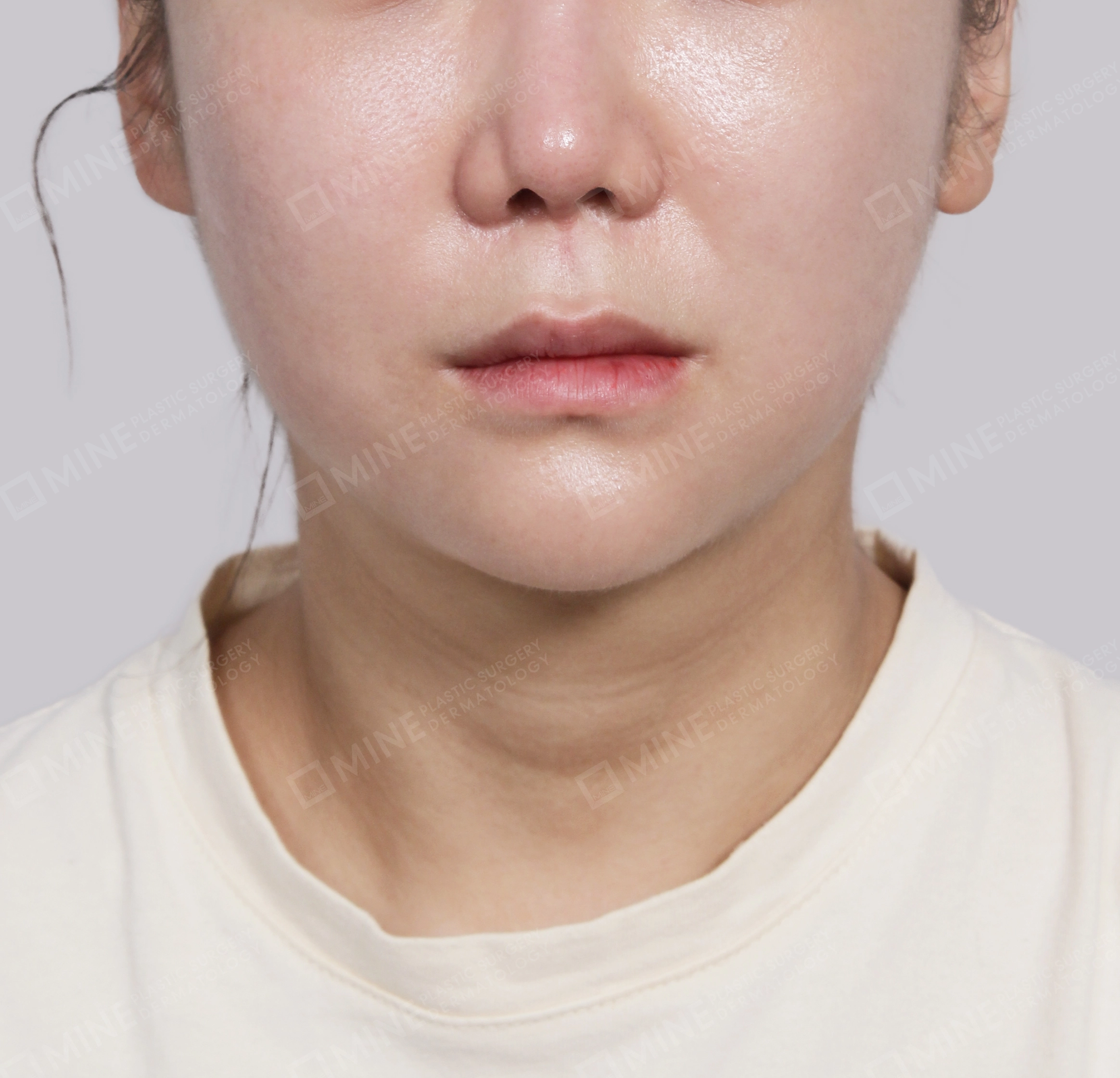 Double Chin (Vlimming)-Front-After