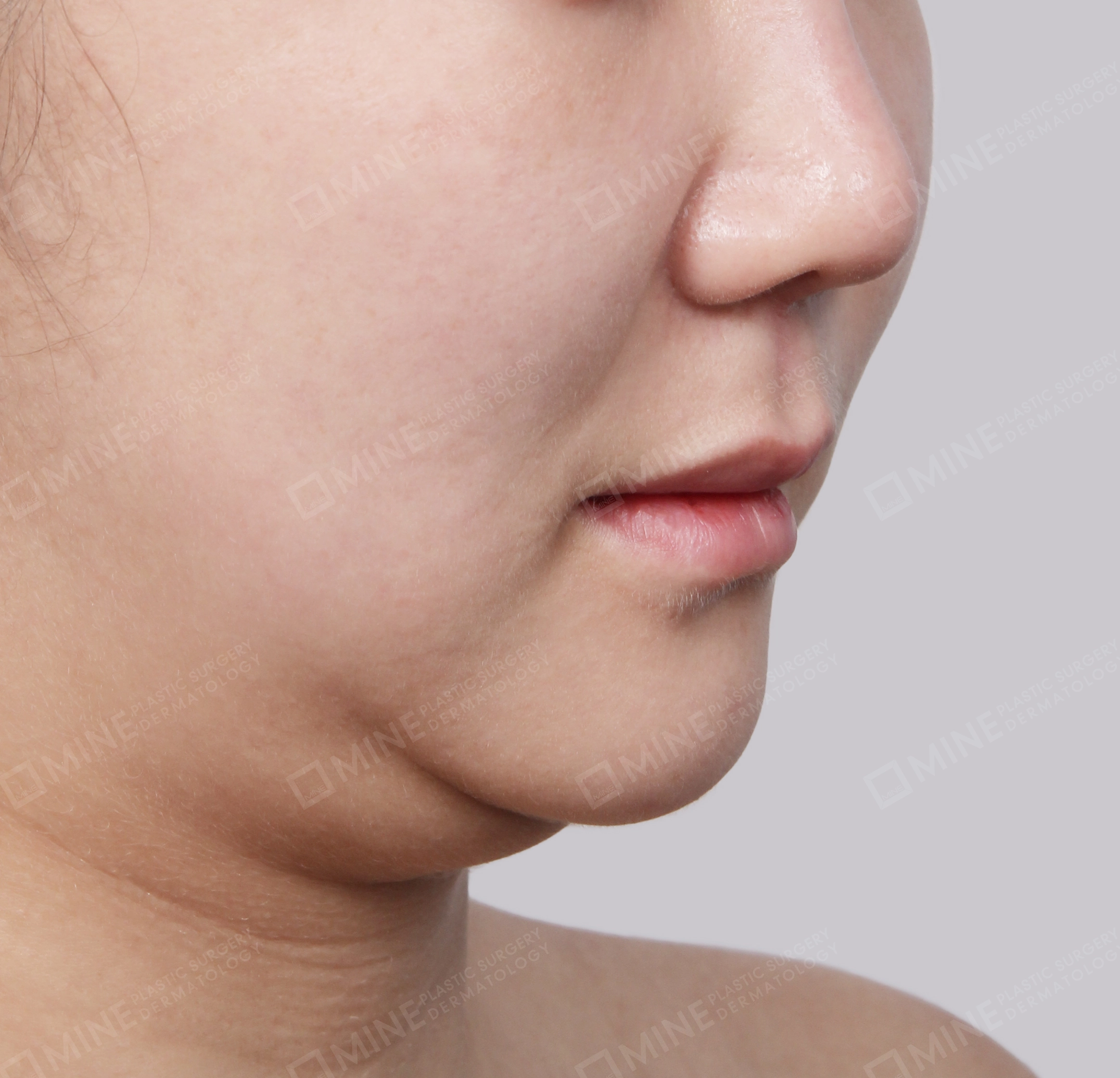 Double Chin (Vlimming)-45-Degree-Before
