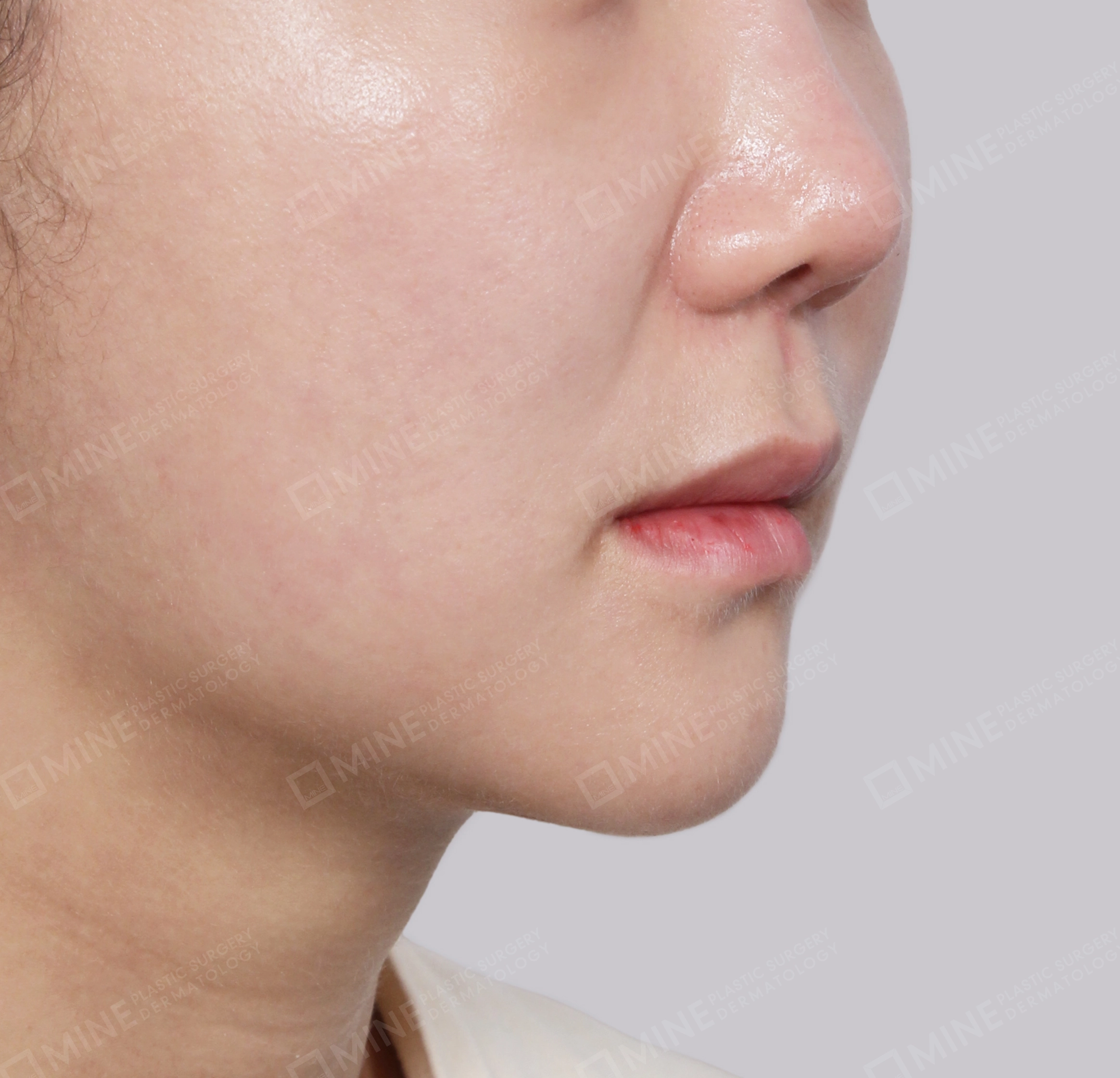 Double Chin (Vlimming)-45-Degree-After