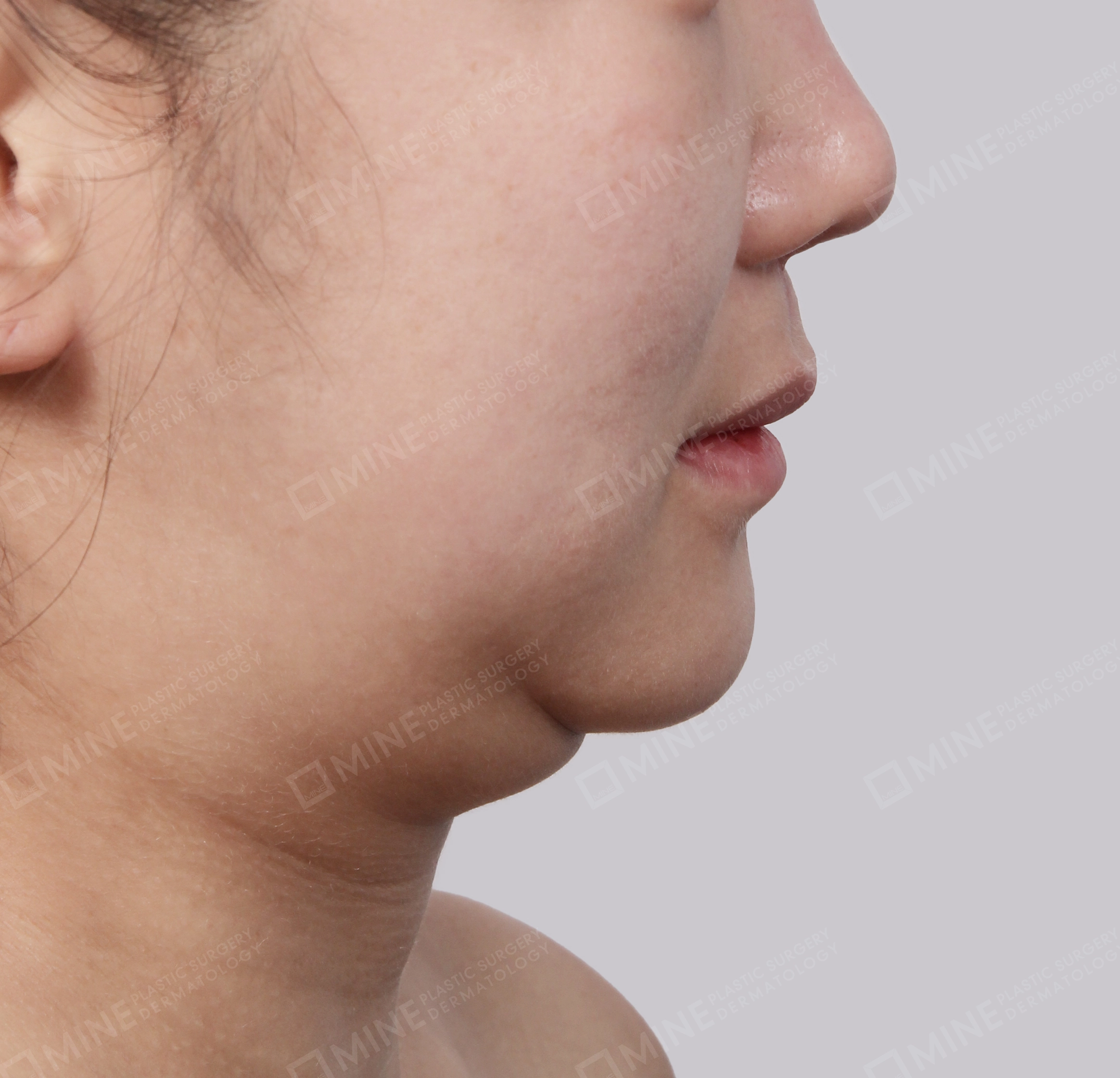 Double Chin (Vlimming)-Side-Before