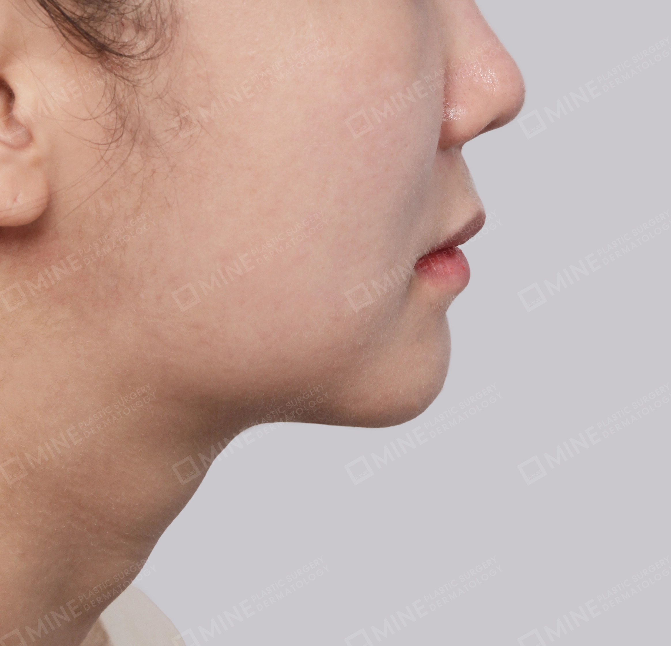 Double Chin (Vlimming)-Side-After