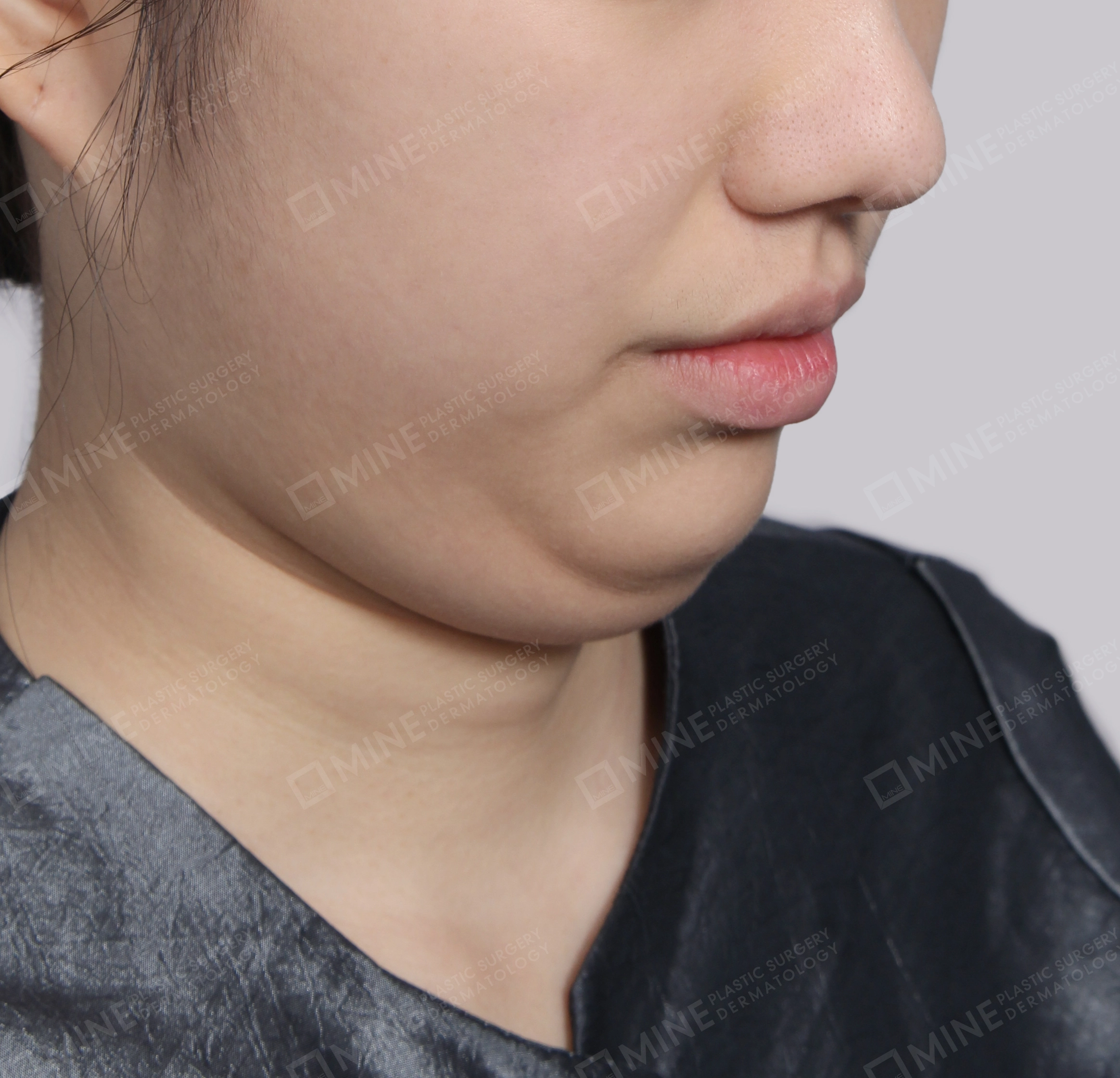 Double Chin (Vlimming)-Front-Before