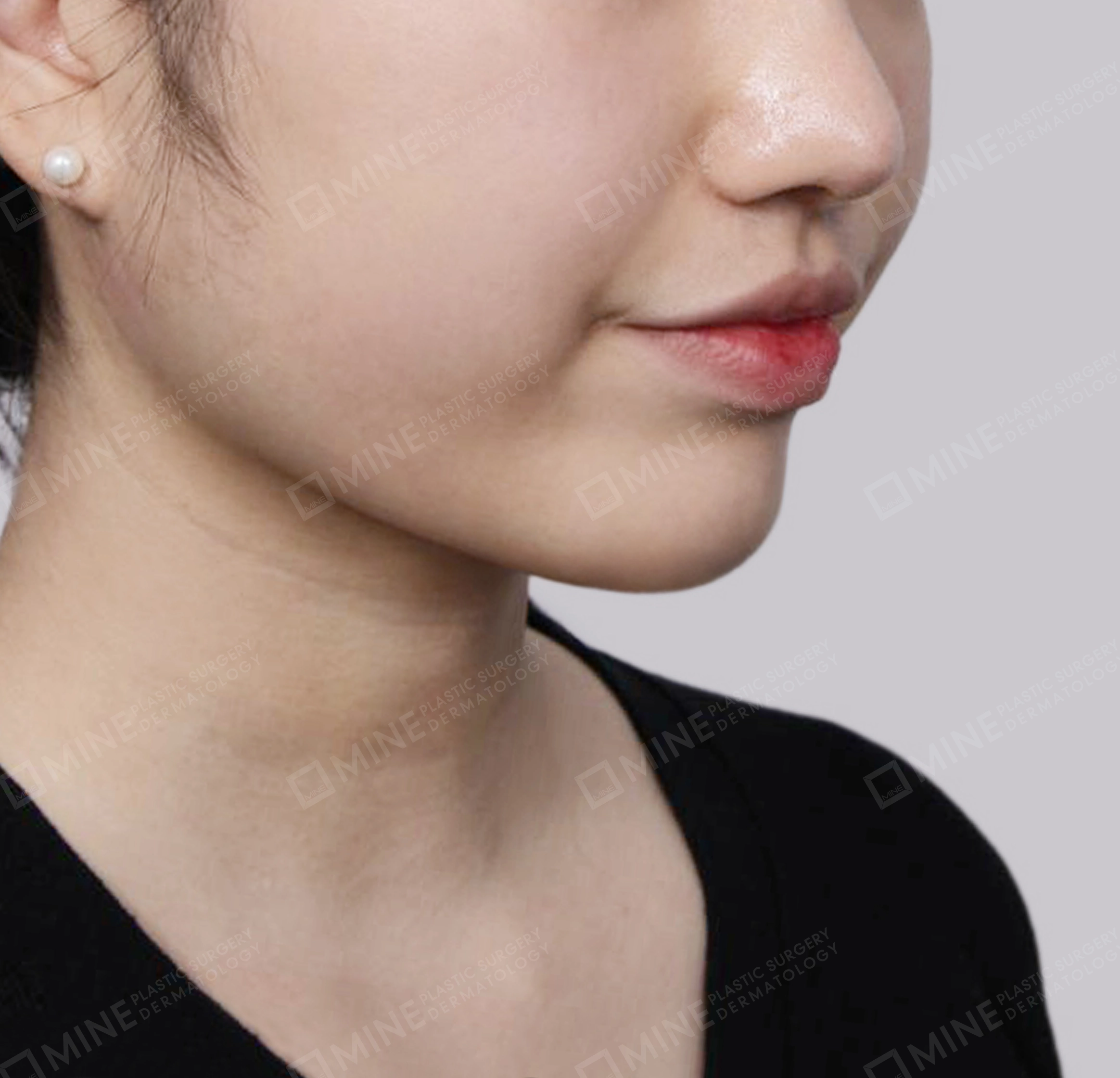 Double Chin (Vlimming)-Front-After