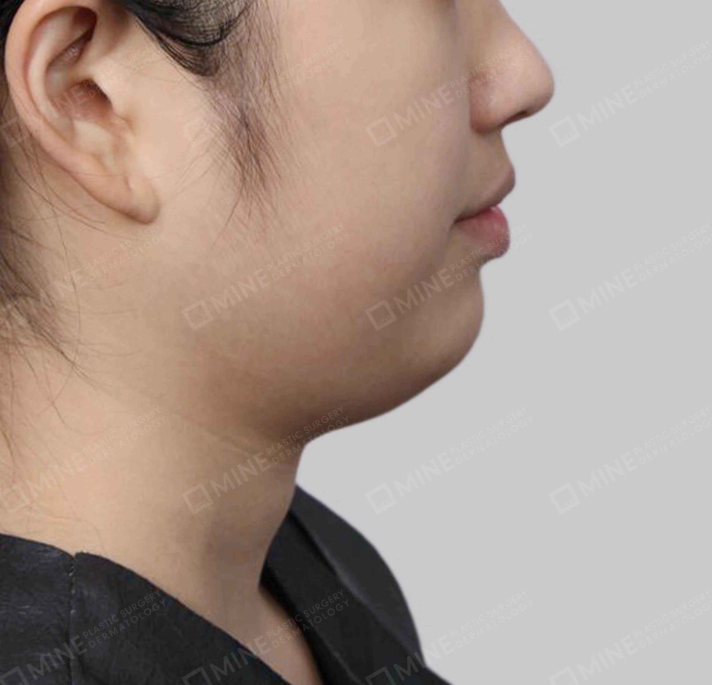 Double Chin (Vlimming)-Side-Before