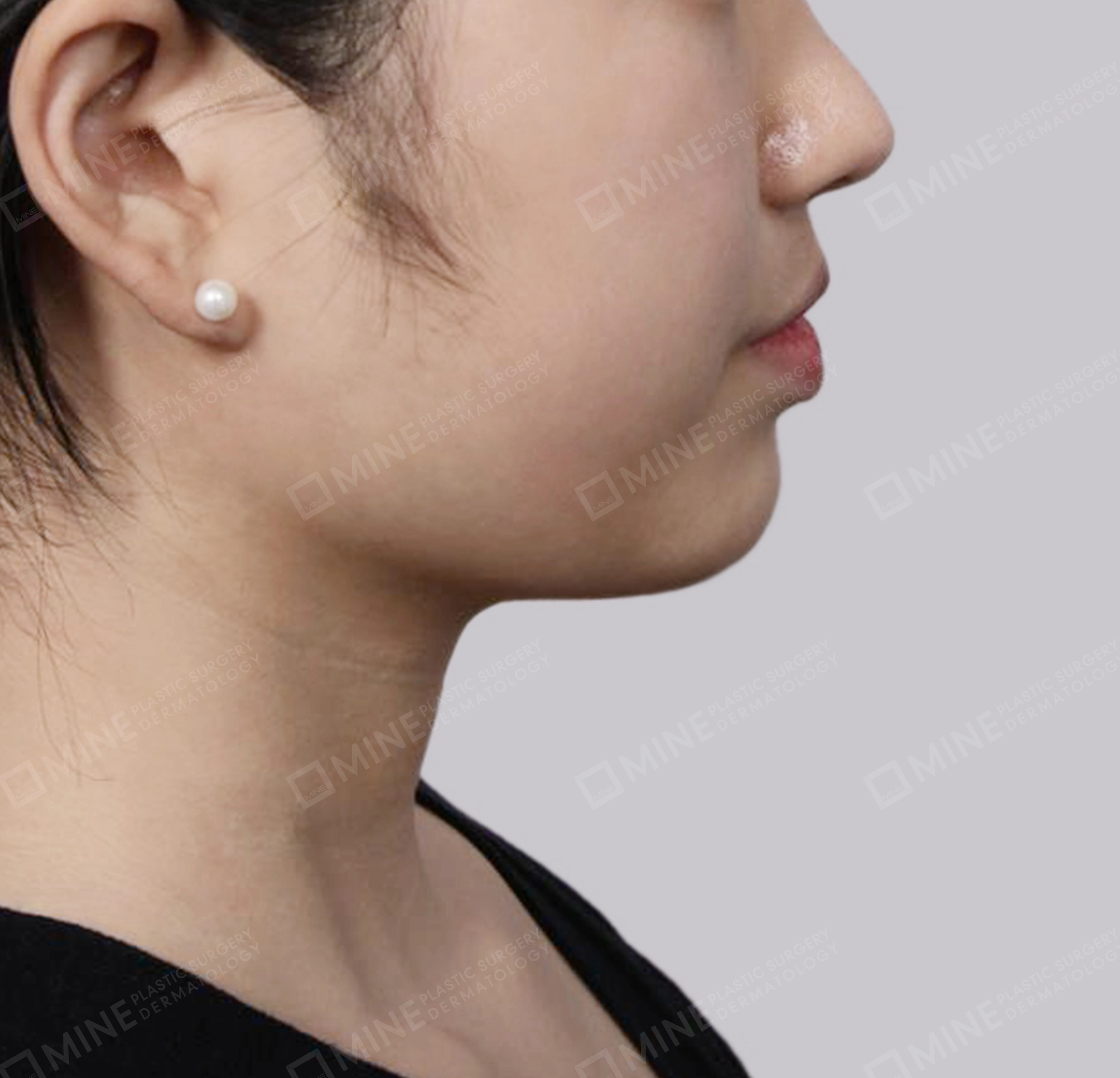 Double Chin (Vlimming)-Side-After