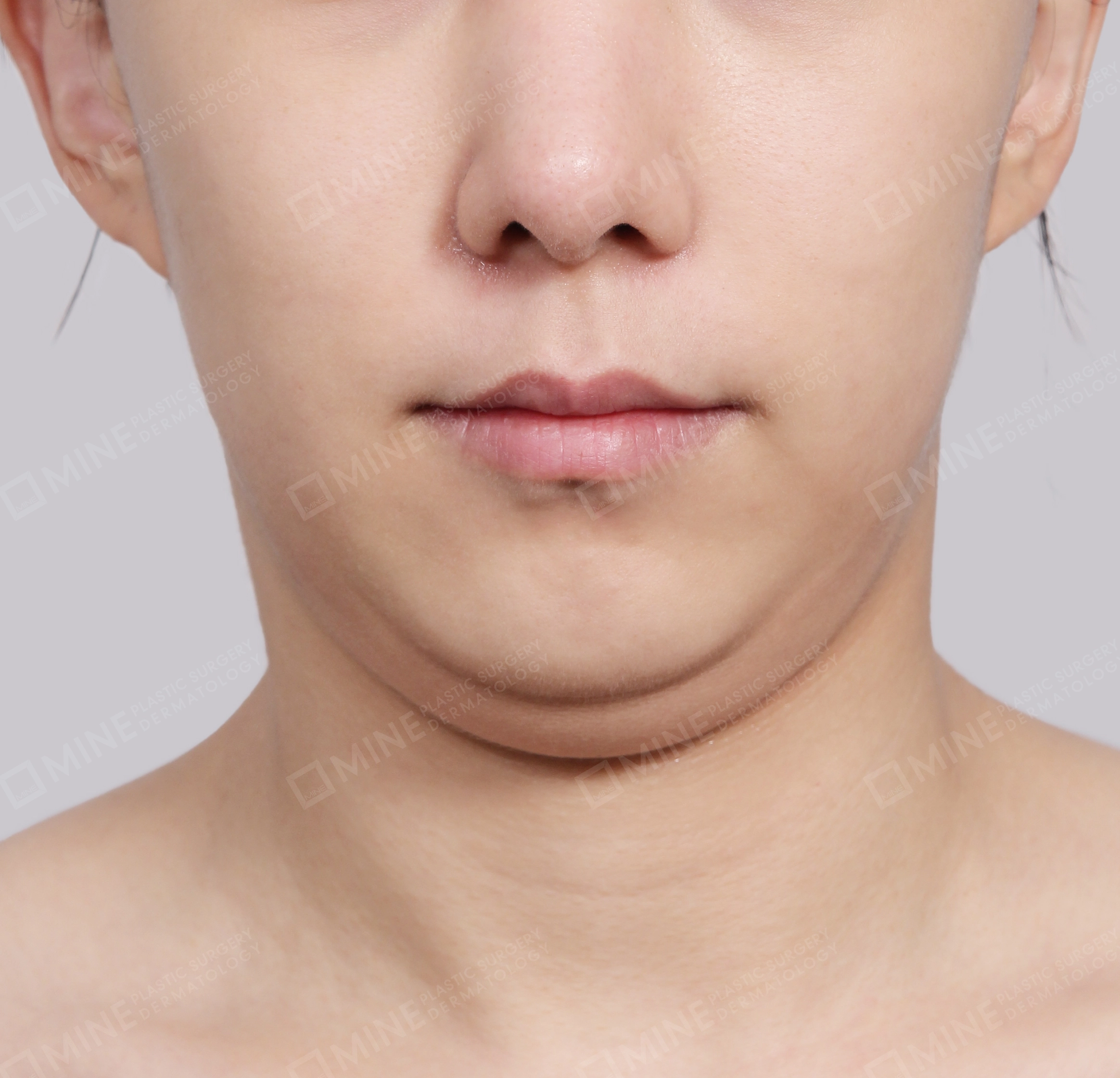Double Chin (Vlimming)-Front-Before