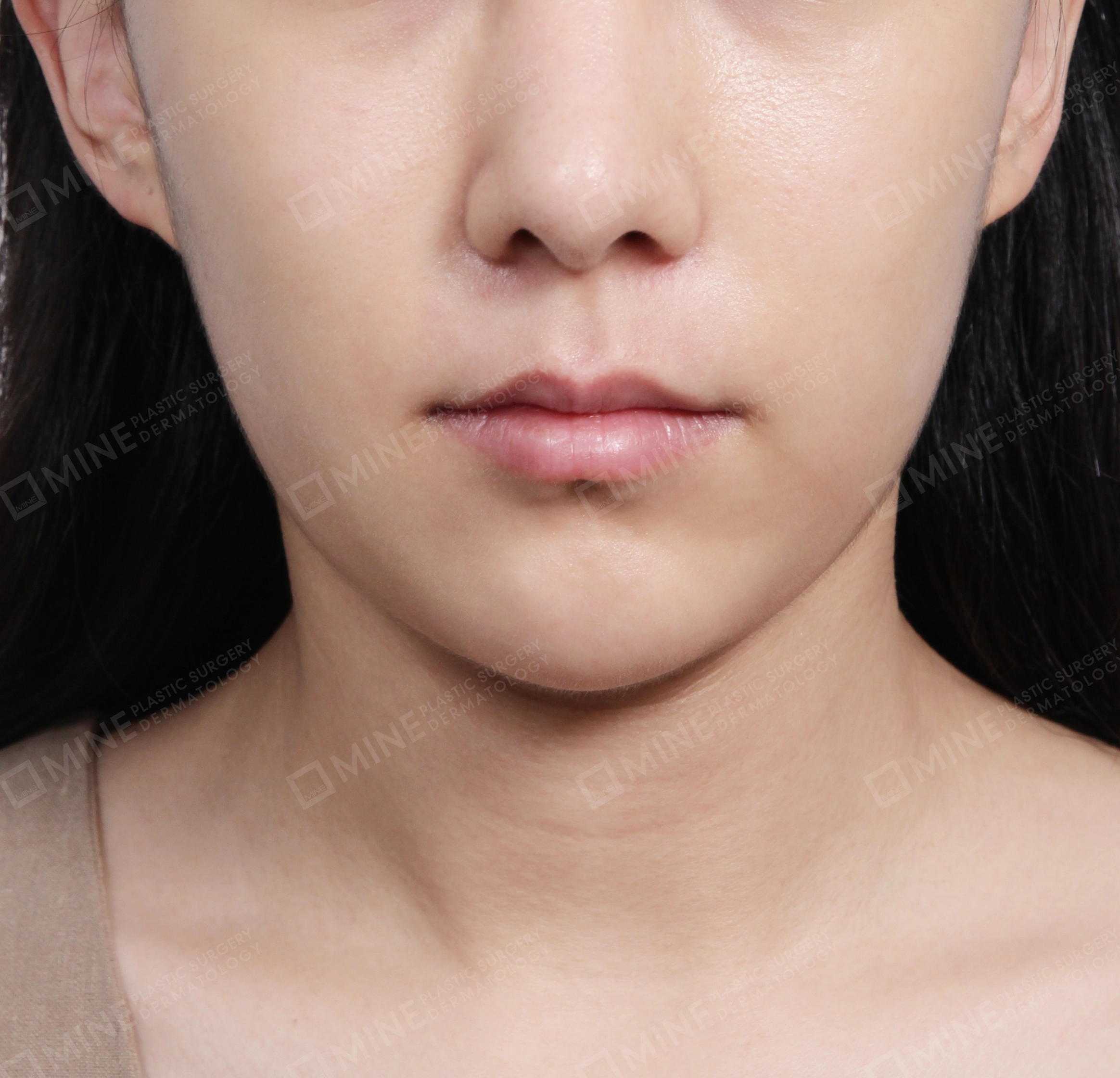 Double Chin (Vlimming)-Front-After