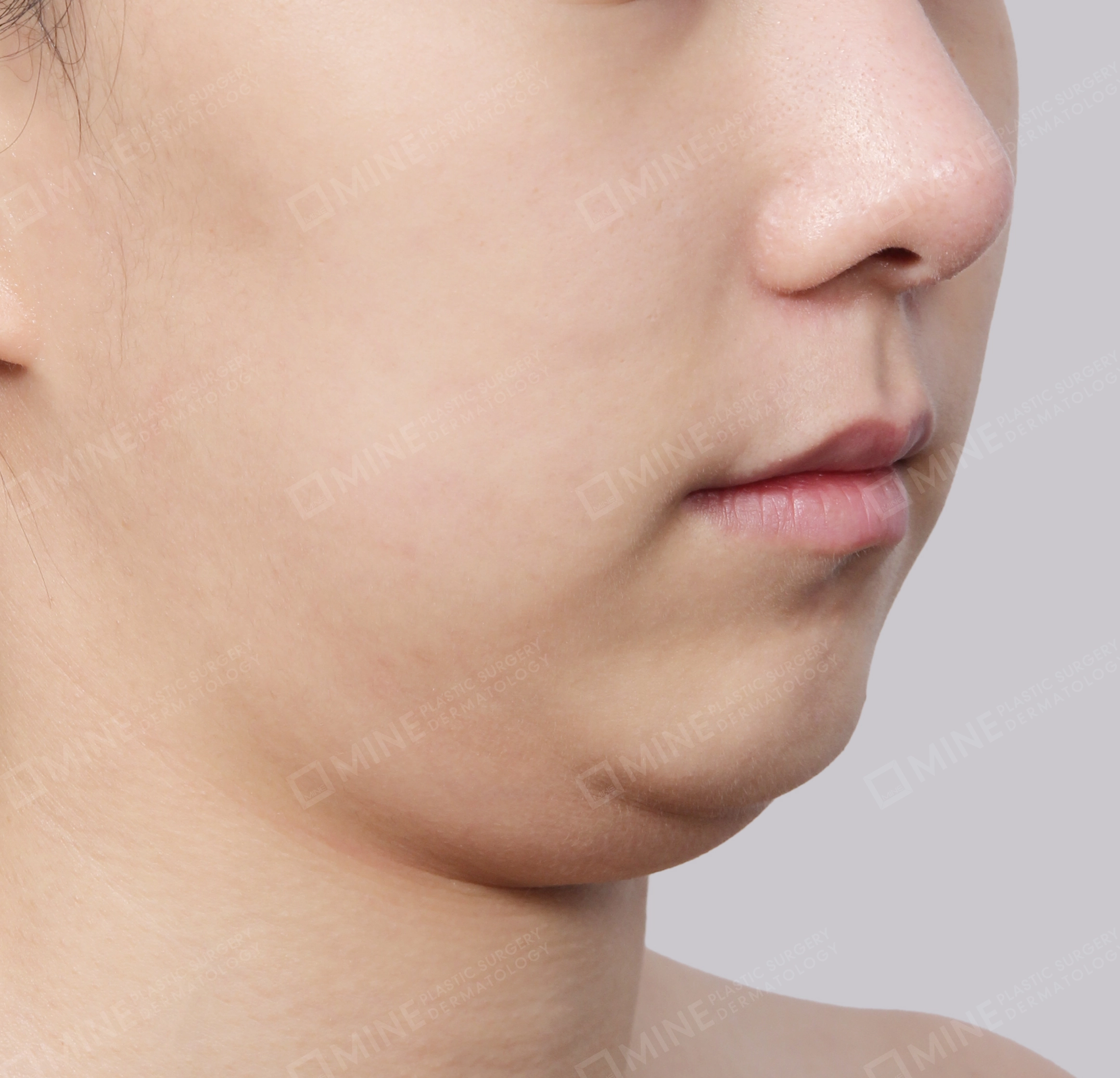 Double Chin (Vlimming)-45-Degree-Before