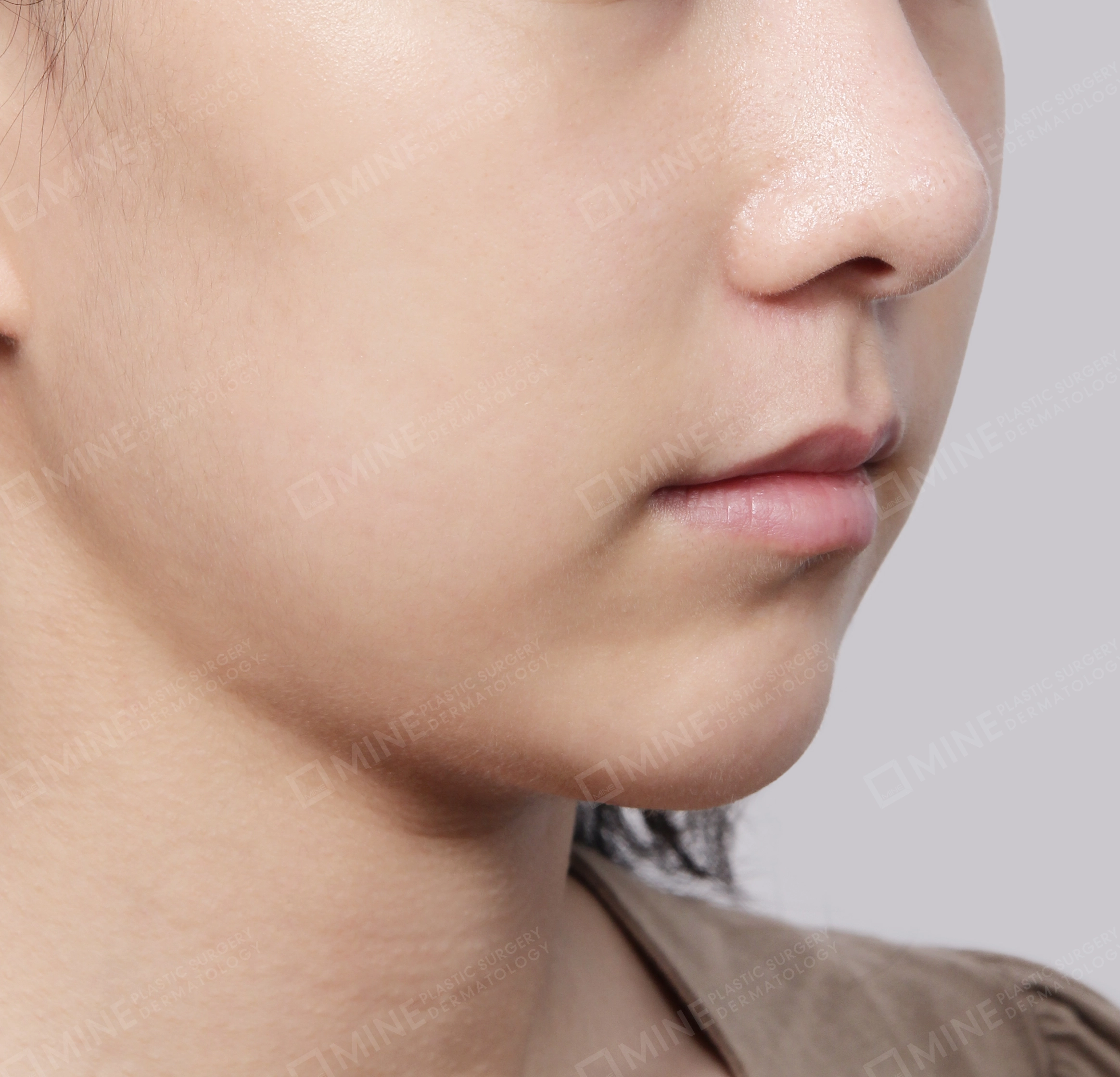 Double Chin (Vlimming)-45-Degree-After