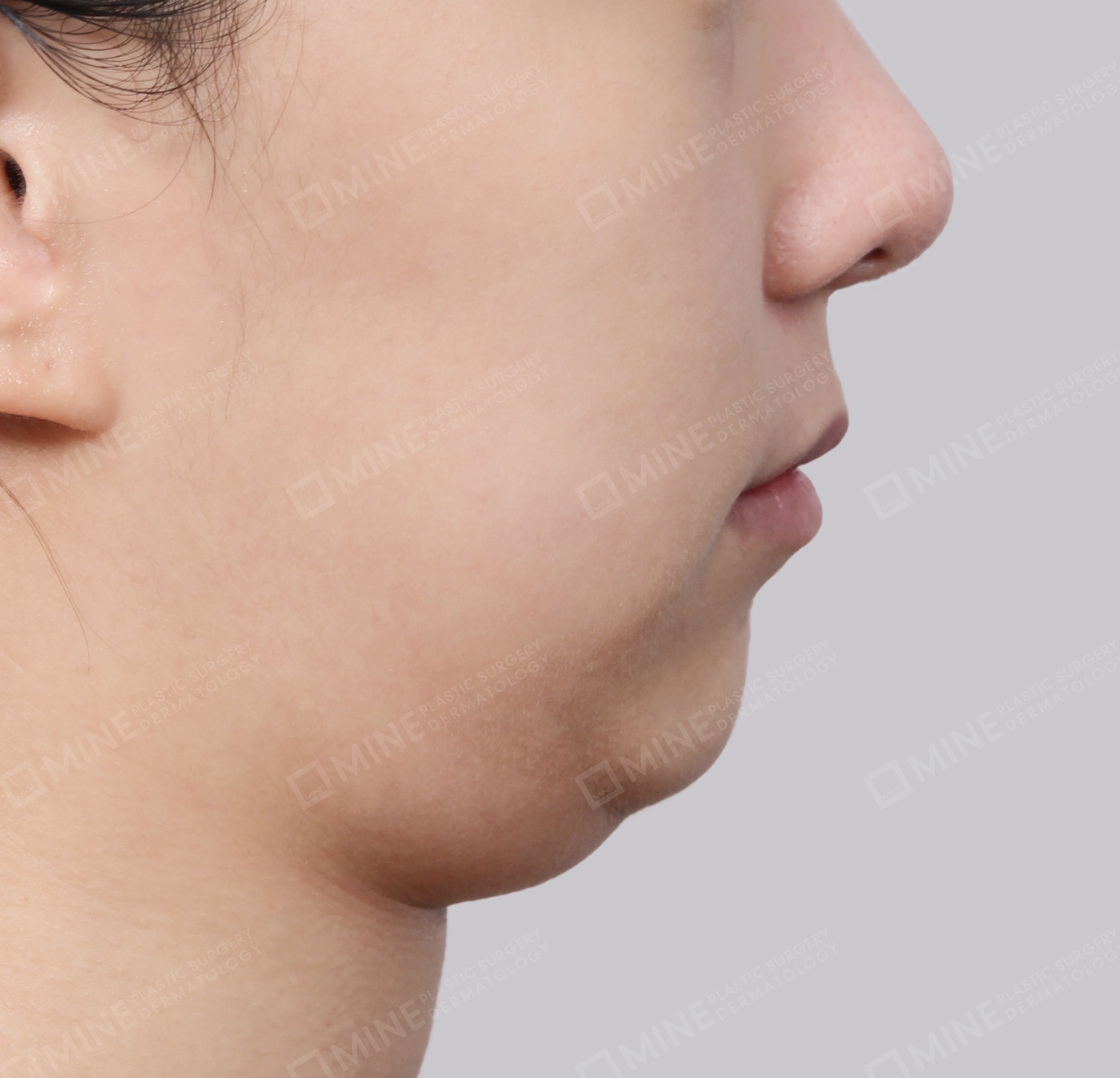 Double Chin (Vlimming)-Side-Before