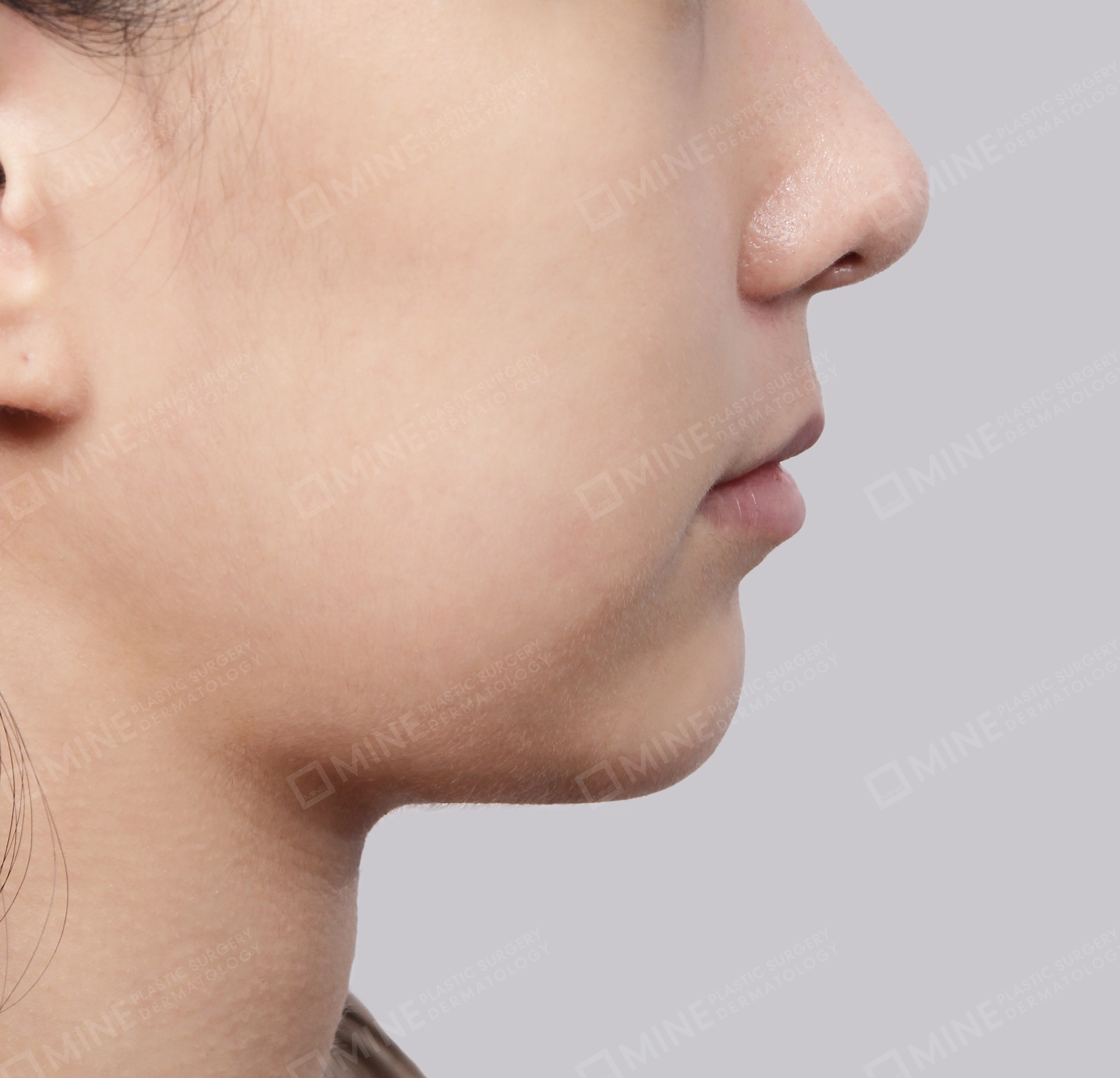 Double Chin (Vlimming)-Side-After