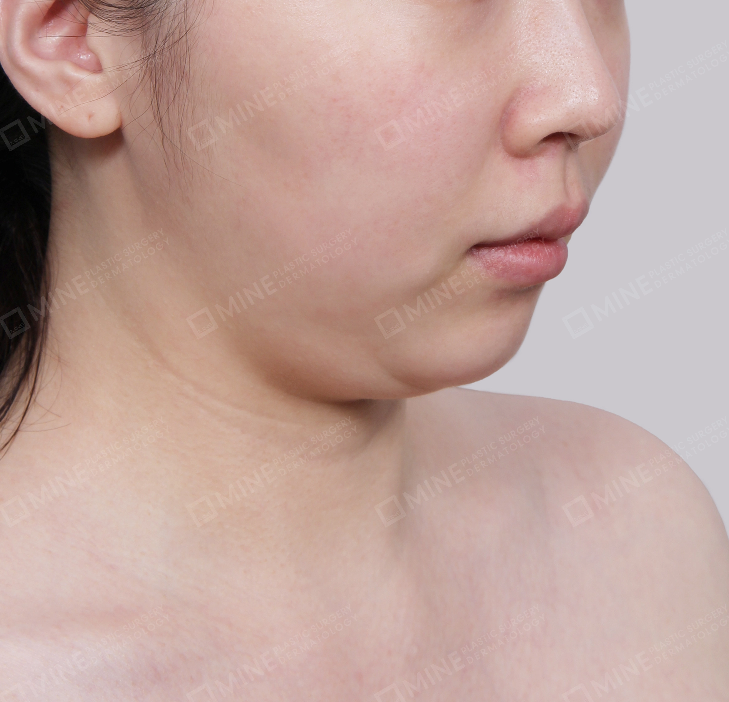 Double Chin (Vlimming)-Front-Before