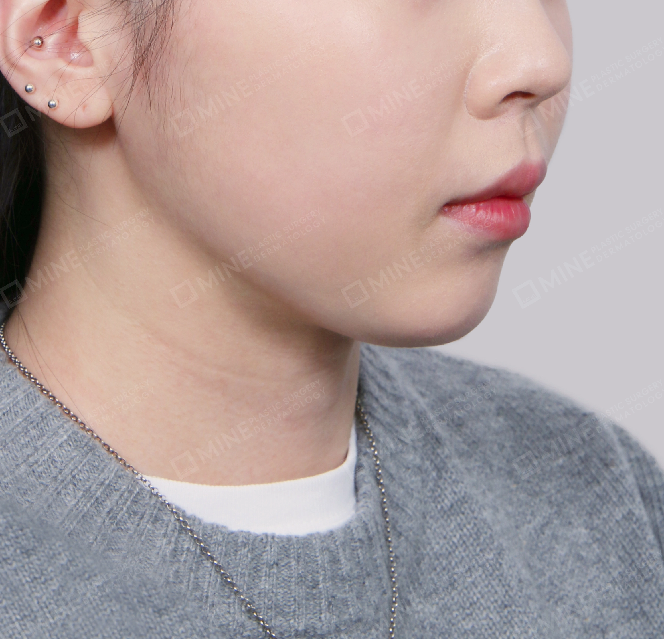 Double Chin (Vlimming)-Front-After