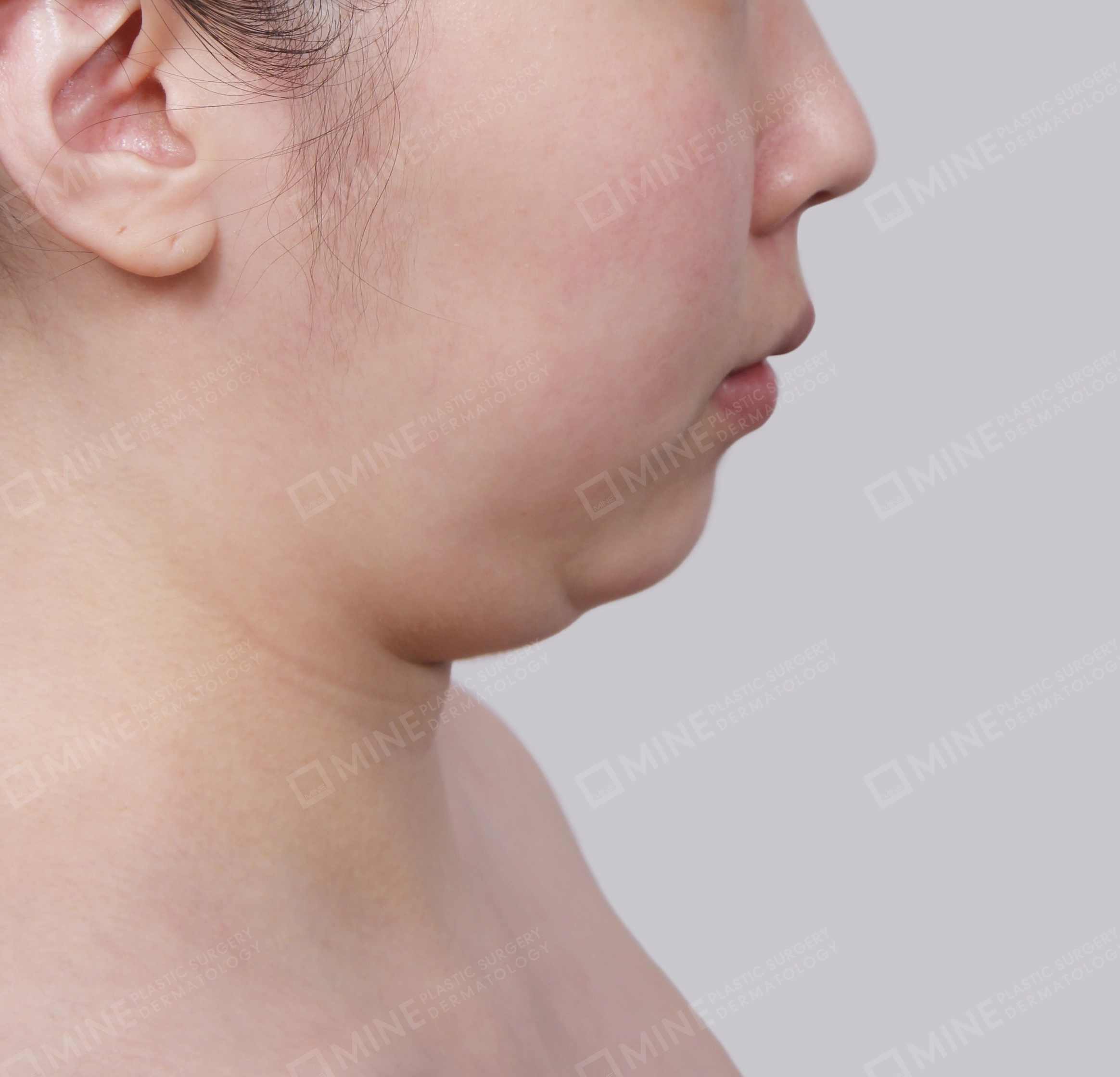 Double Chin (Vlimming)-Side-Before