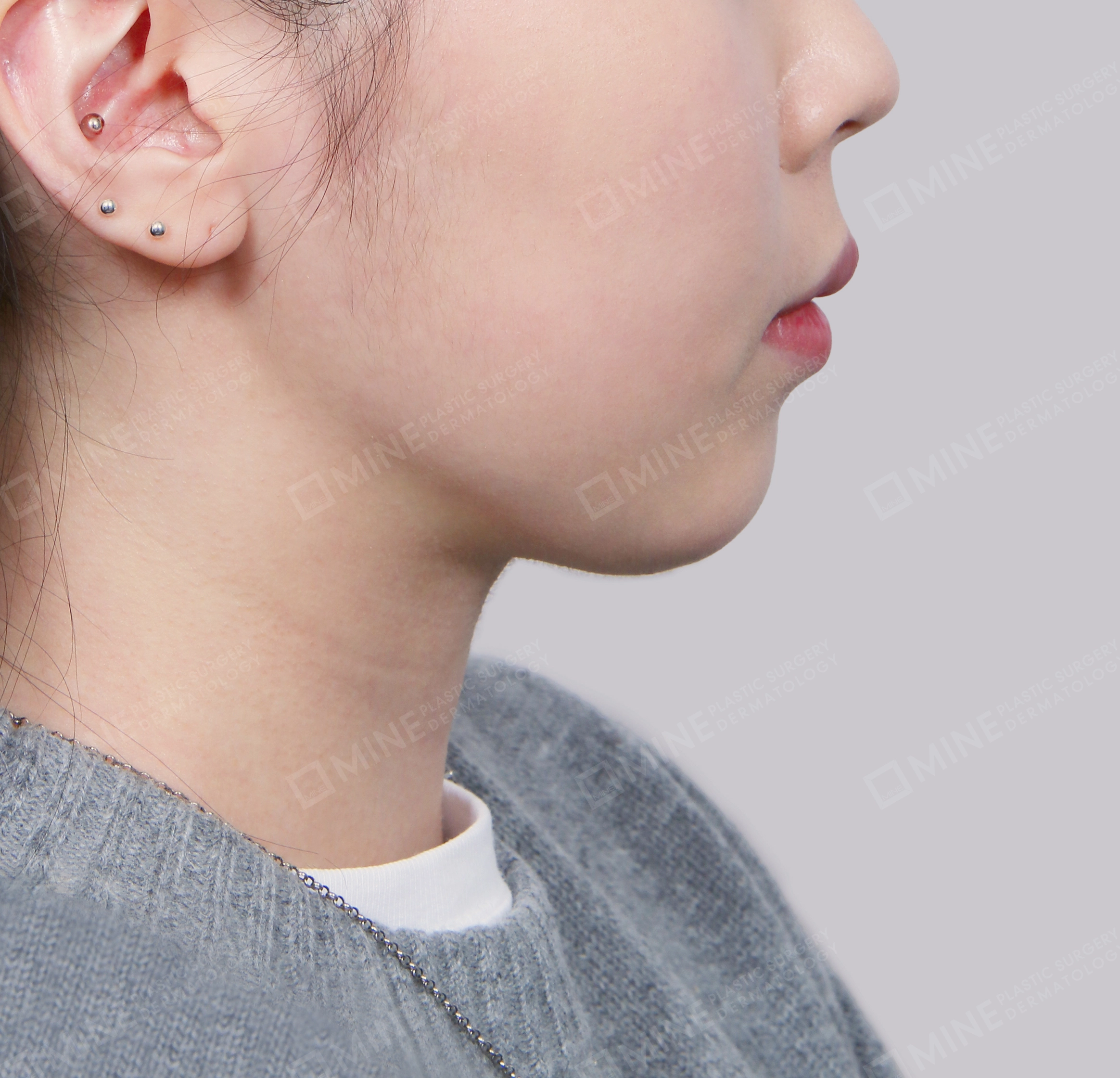 Double Chin (Vlimming)-Side-After