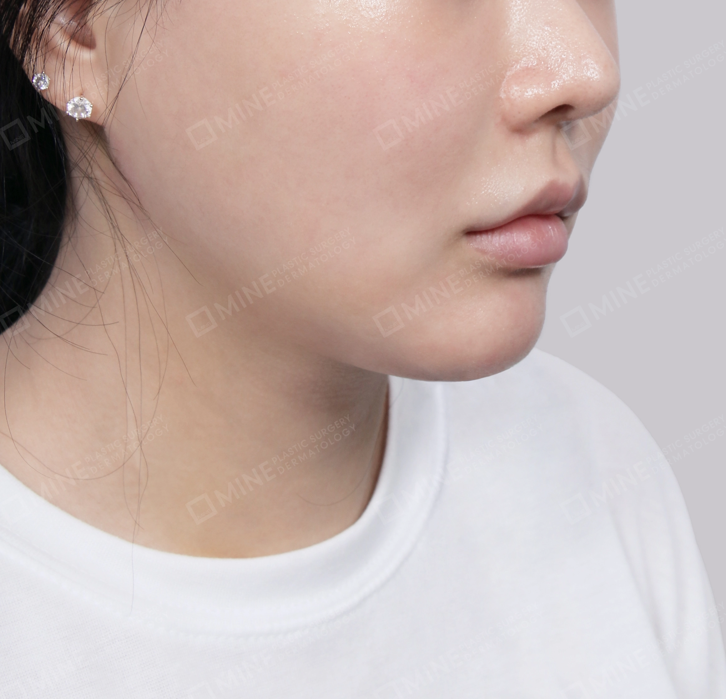 Double Chin (Vlimming)-Front-After