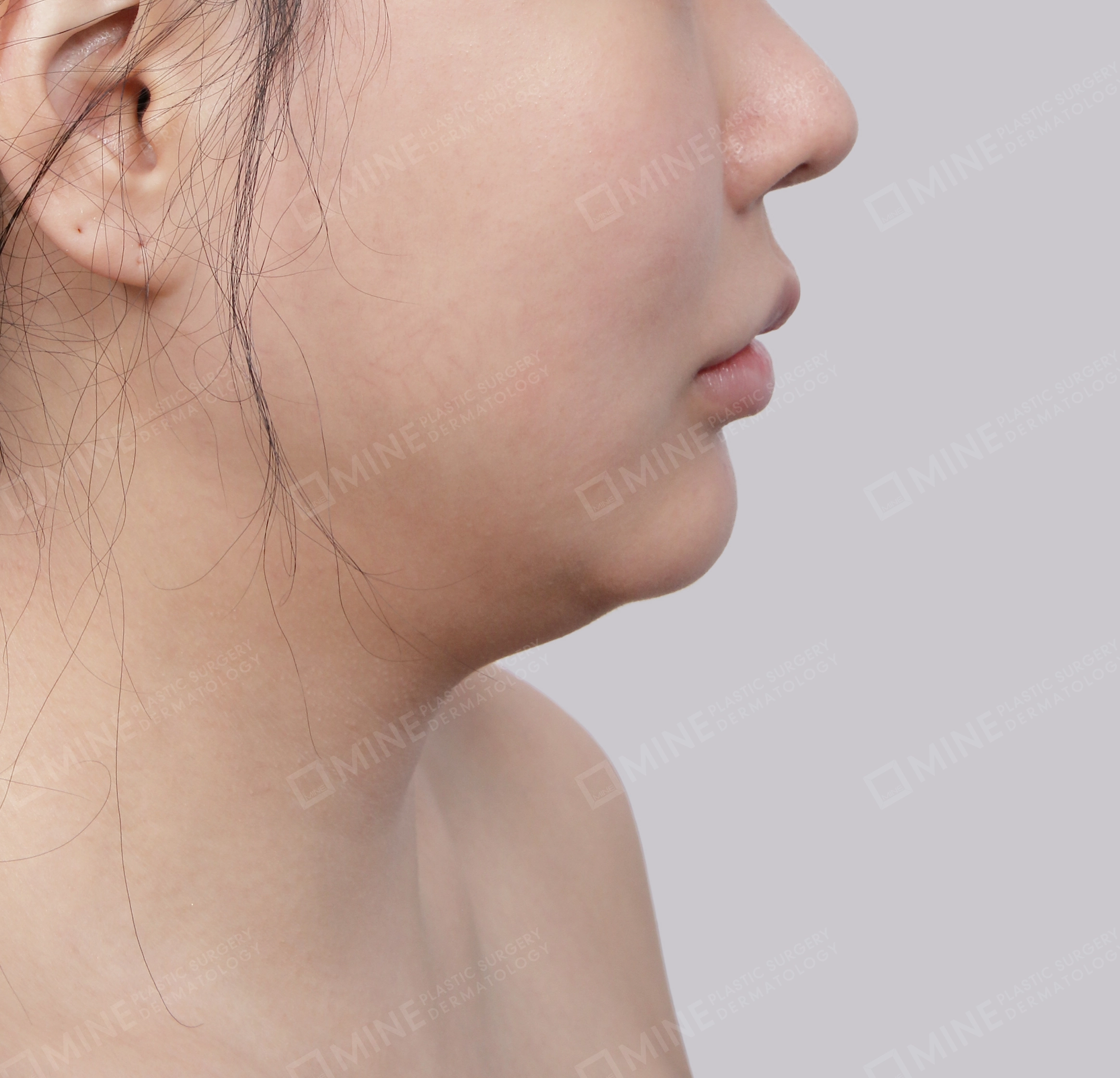 Double Chin (Vlimming)-Side-Before