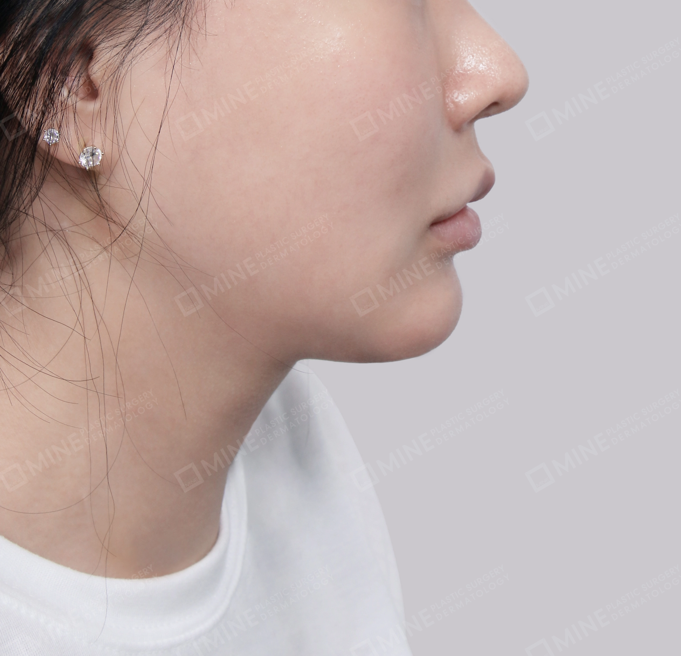 Double Chin (Vlimming)-Side-After