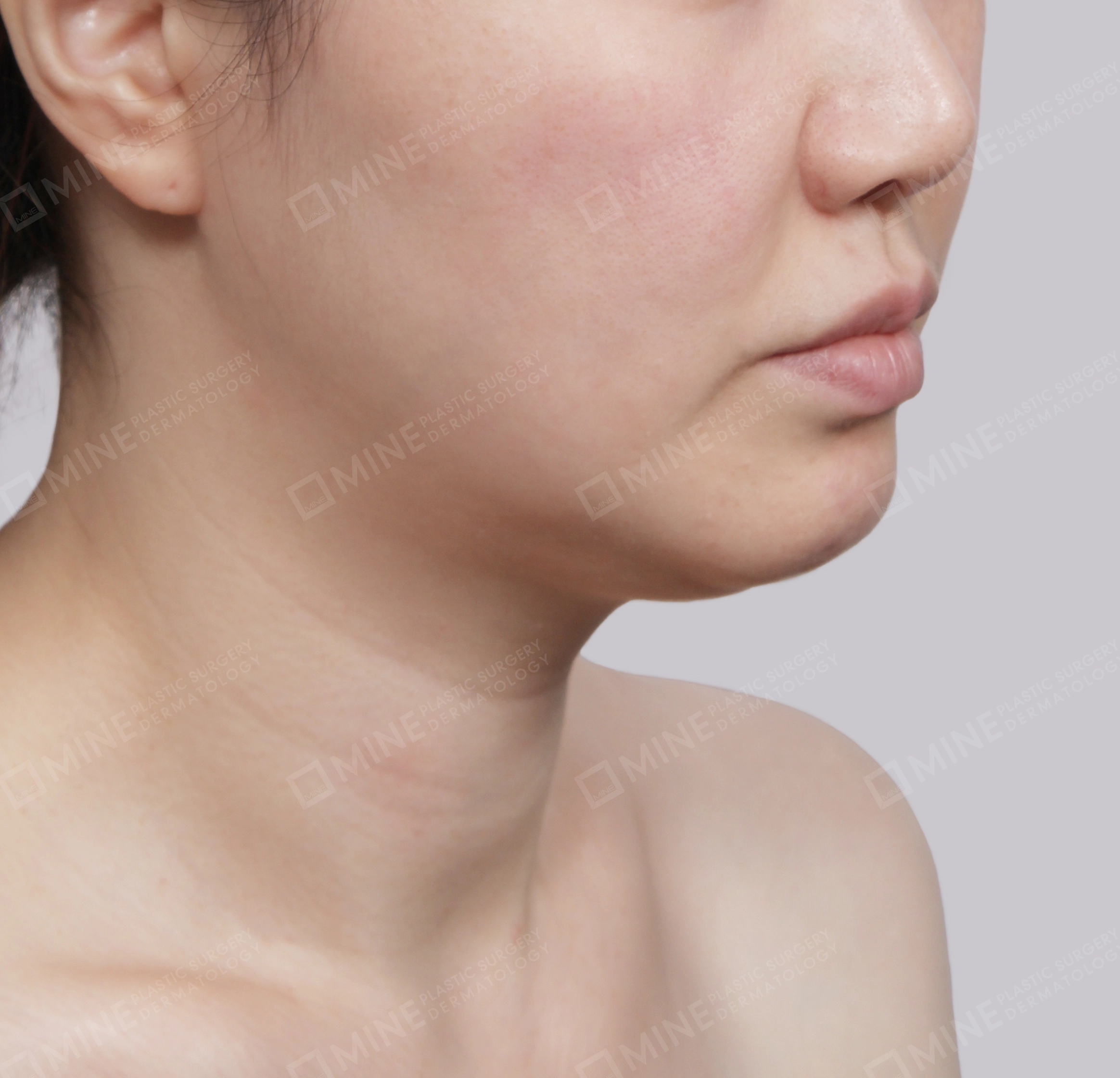Double Chin (Vlimming)-Front-Before