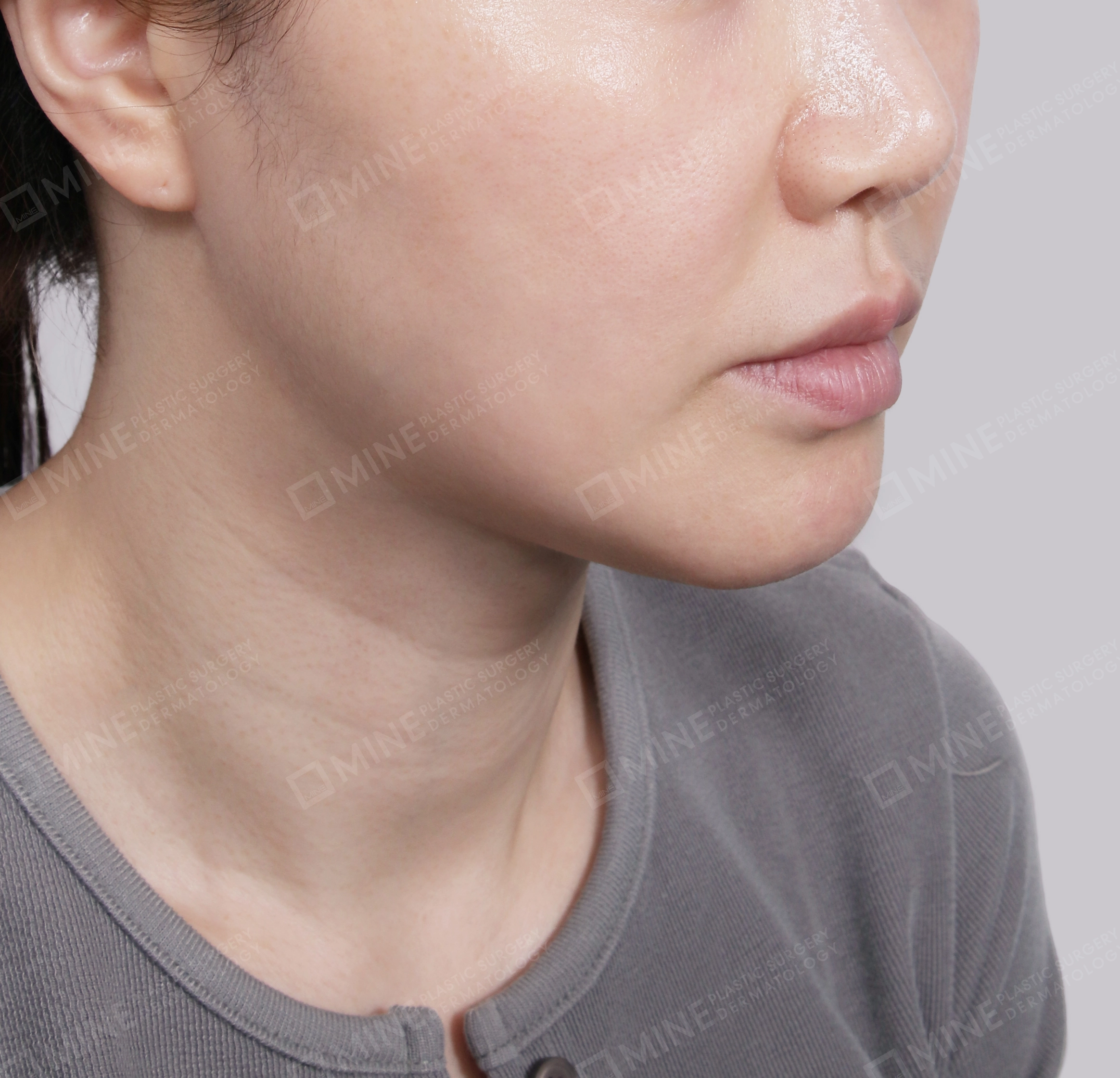 Double Chin (Vlimming)-Front-After