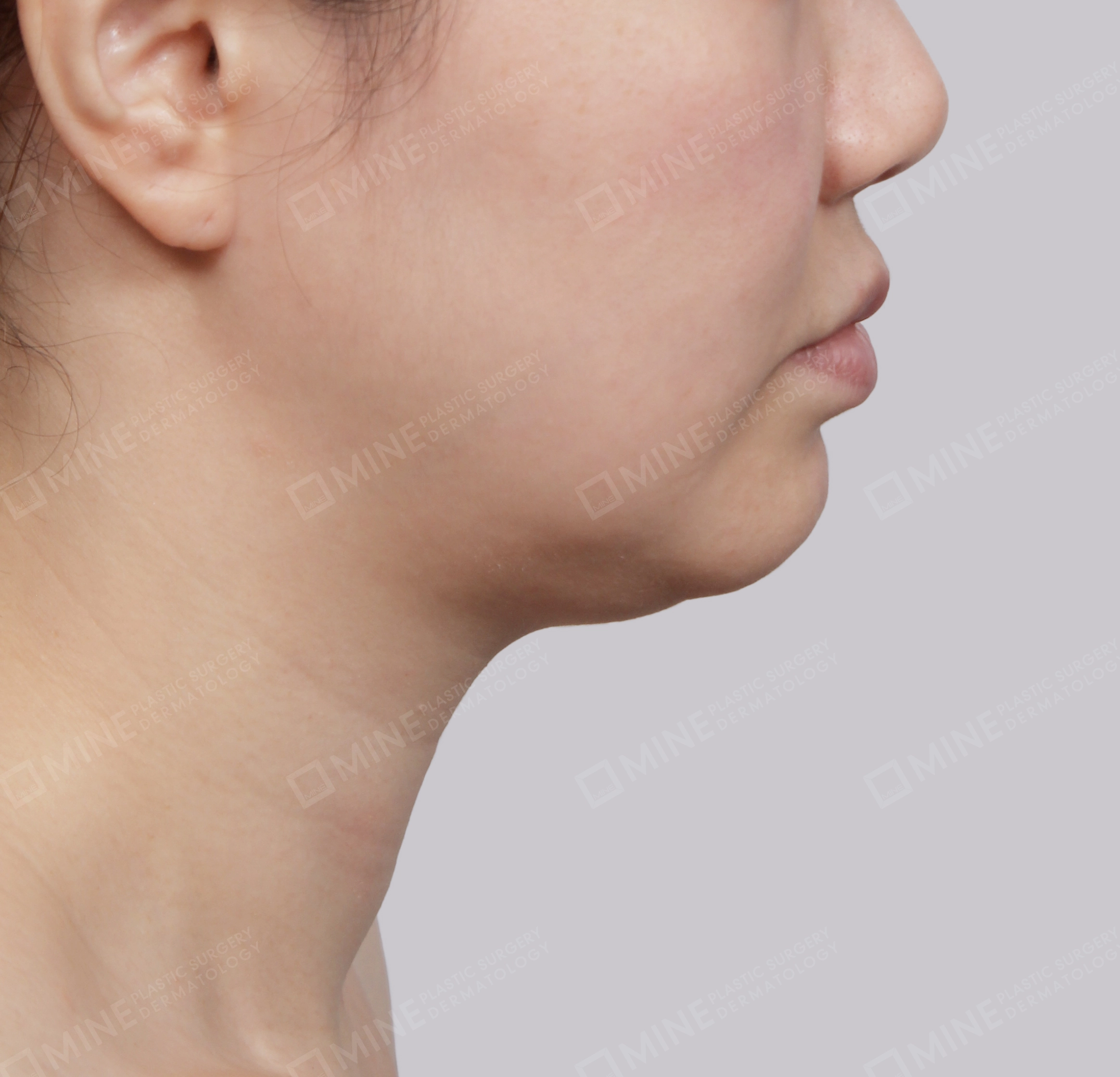 Double Chin (Vlimming)-Side-Before