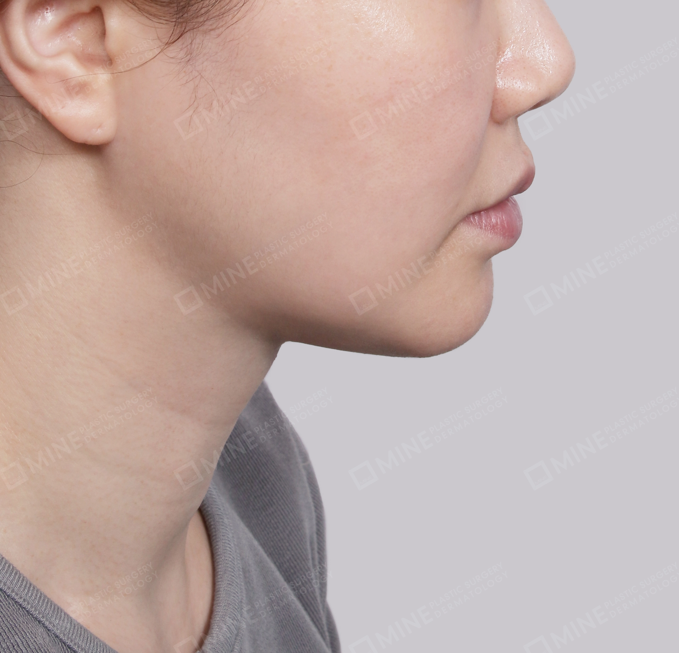 Double Chin (Vlimming)-Side-After
