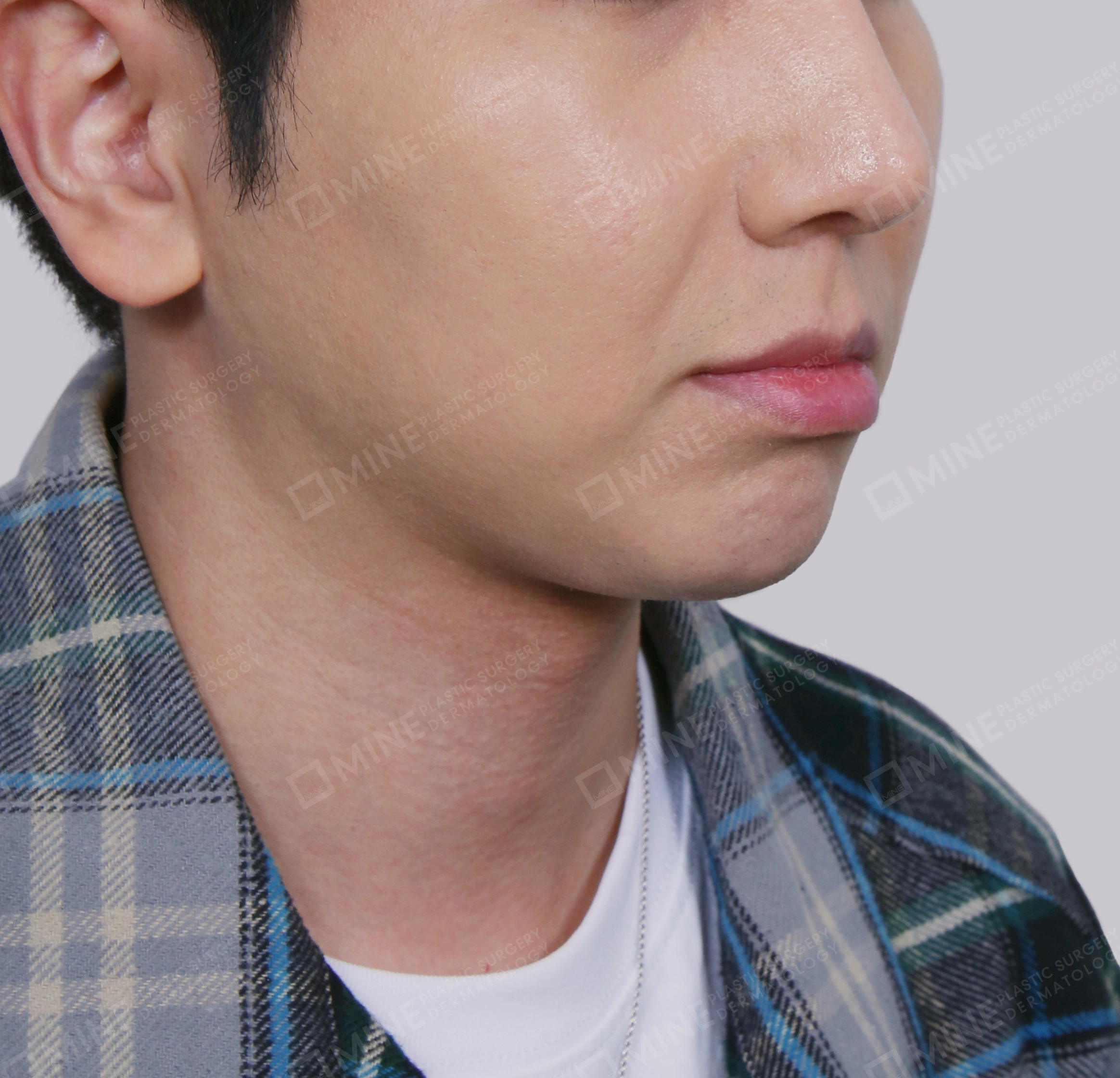 Double Chin (Vlimming)-Front-After