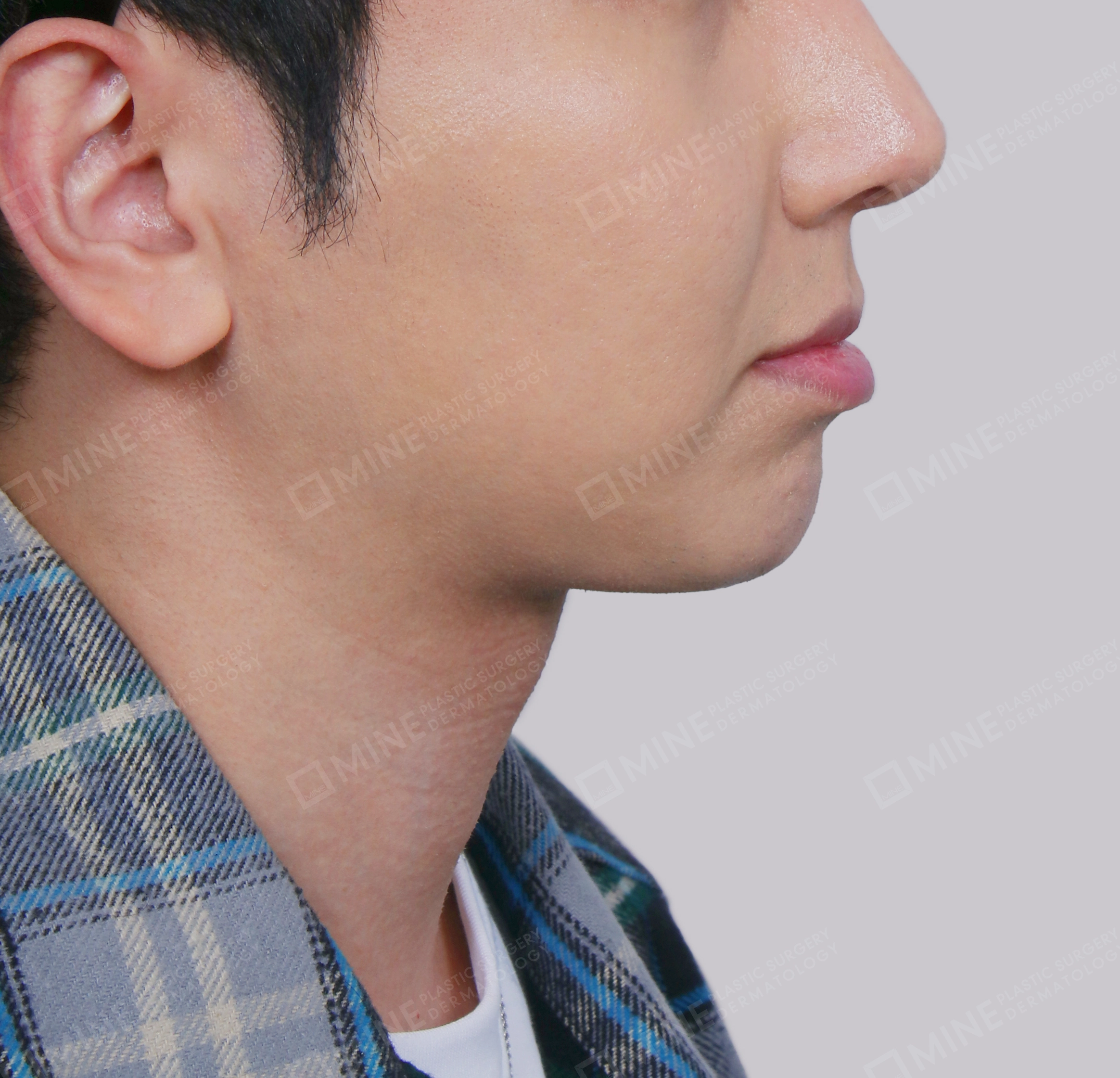 Double Chin (Vlimming)-Side-After