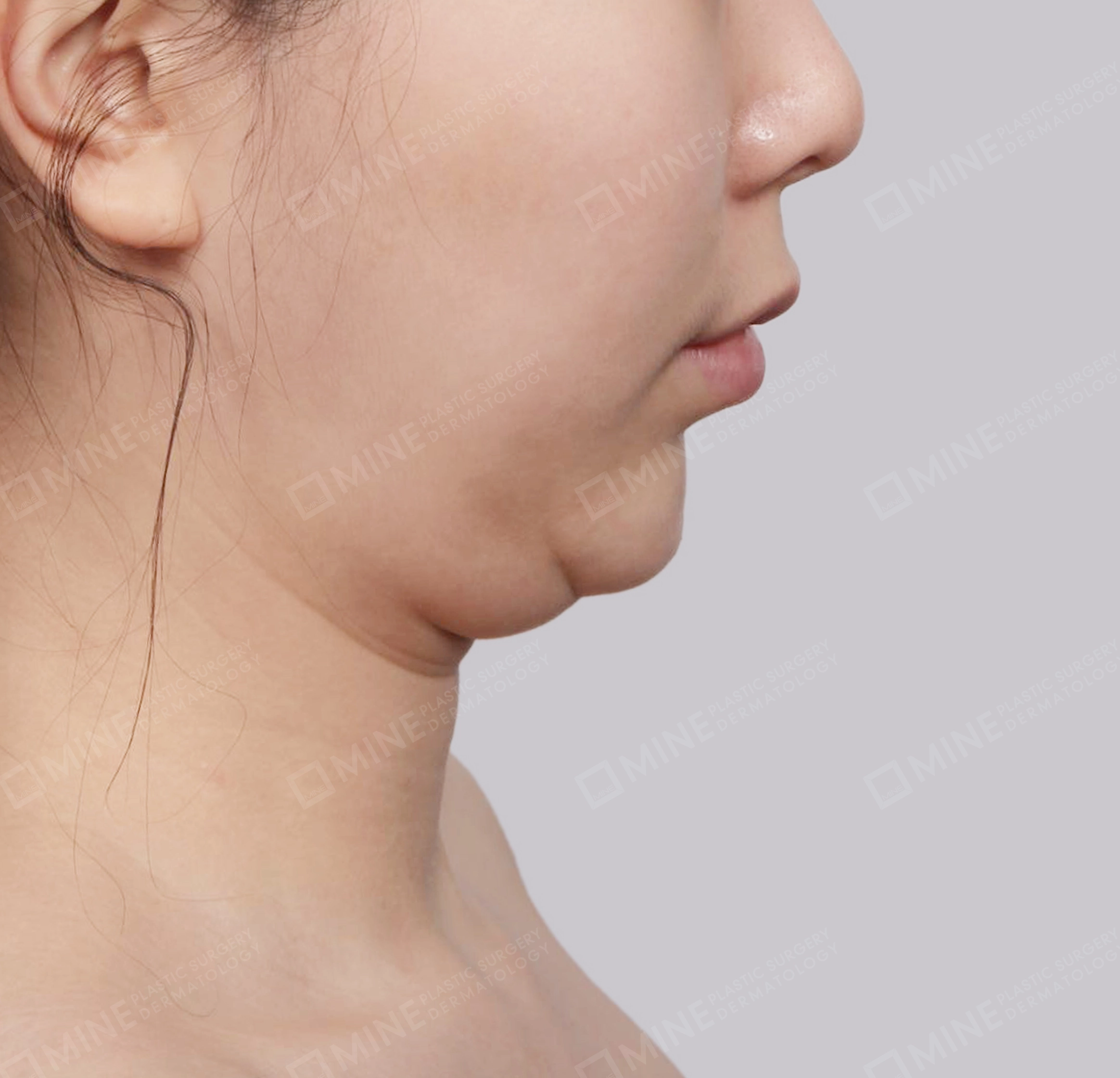 Double Chin (Vlimming)-Side-Before