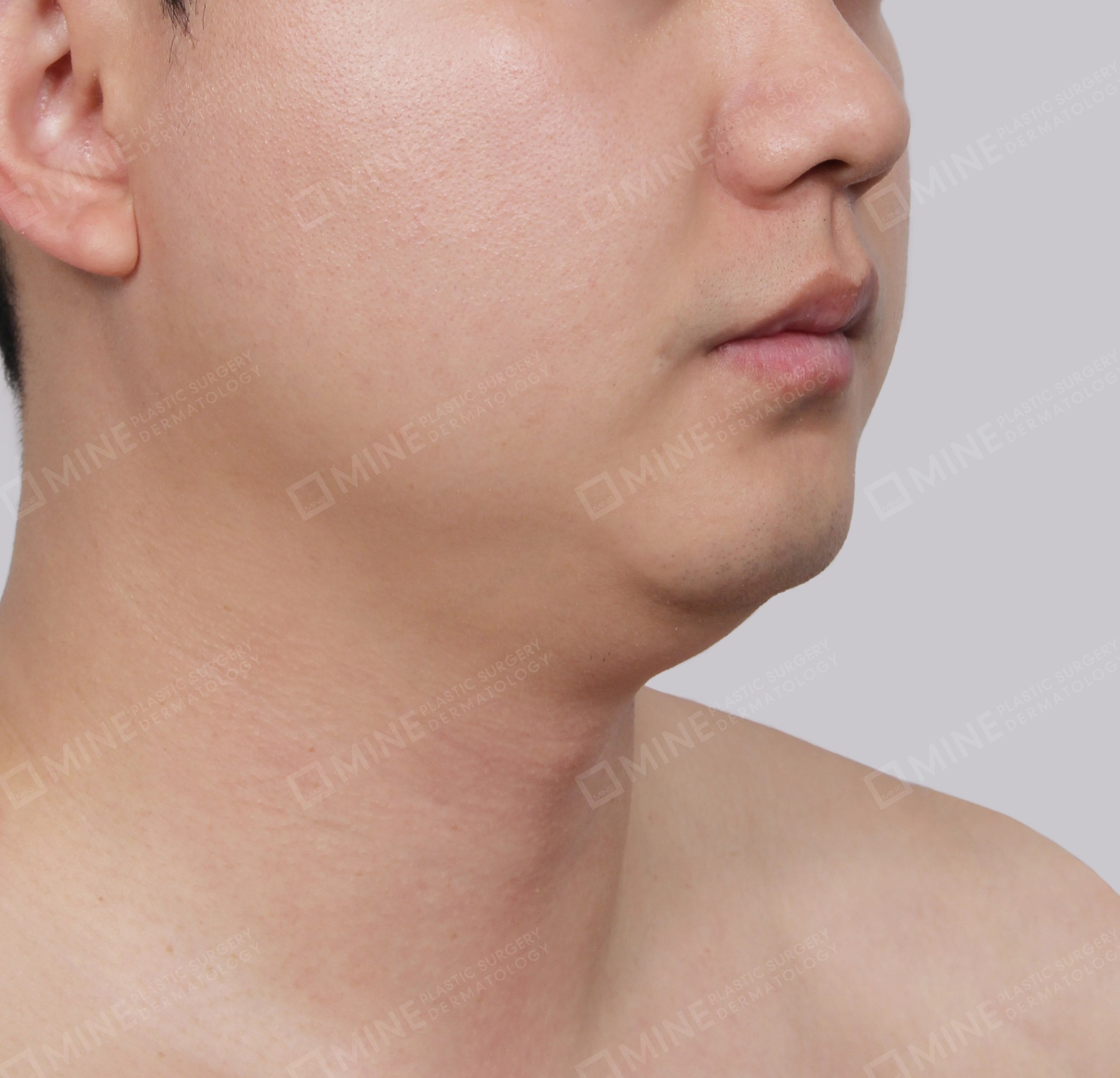 Double Chin (Vlimming)-Front-Before