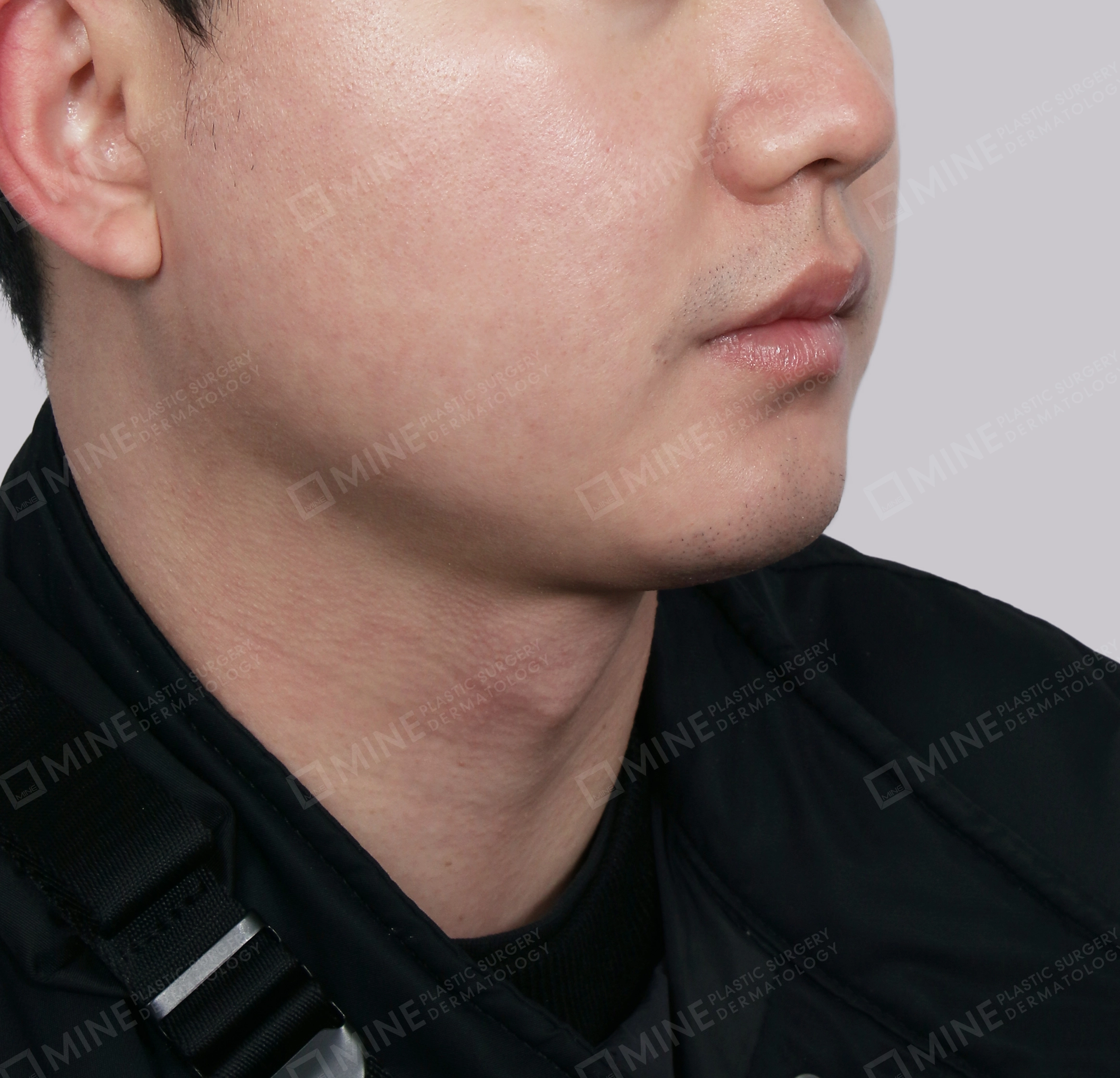 Double Chin (Vlimming)-Front-After
