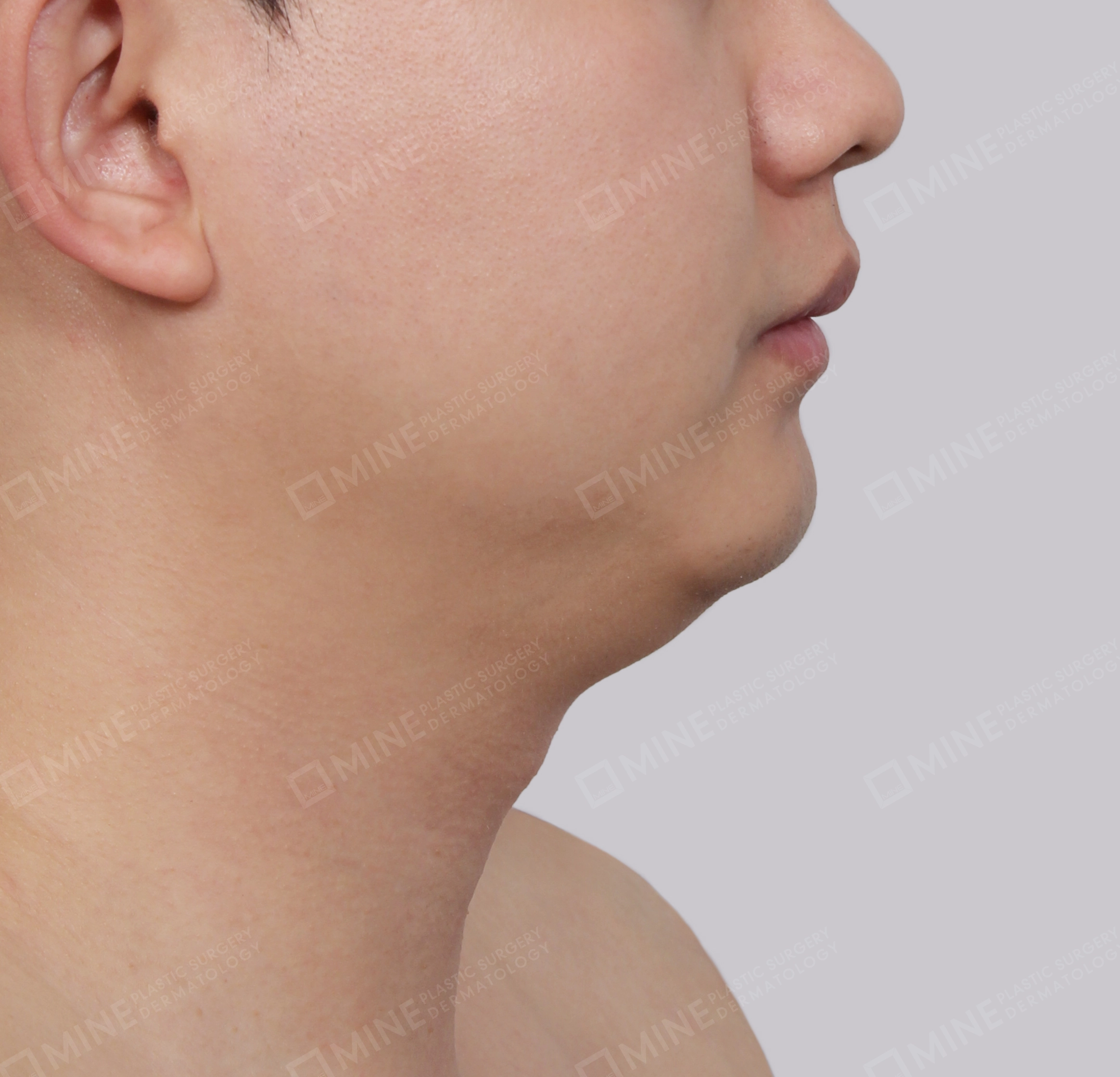 Double Chin (Vlimming)-Side-Before