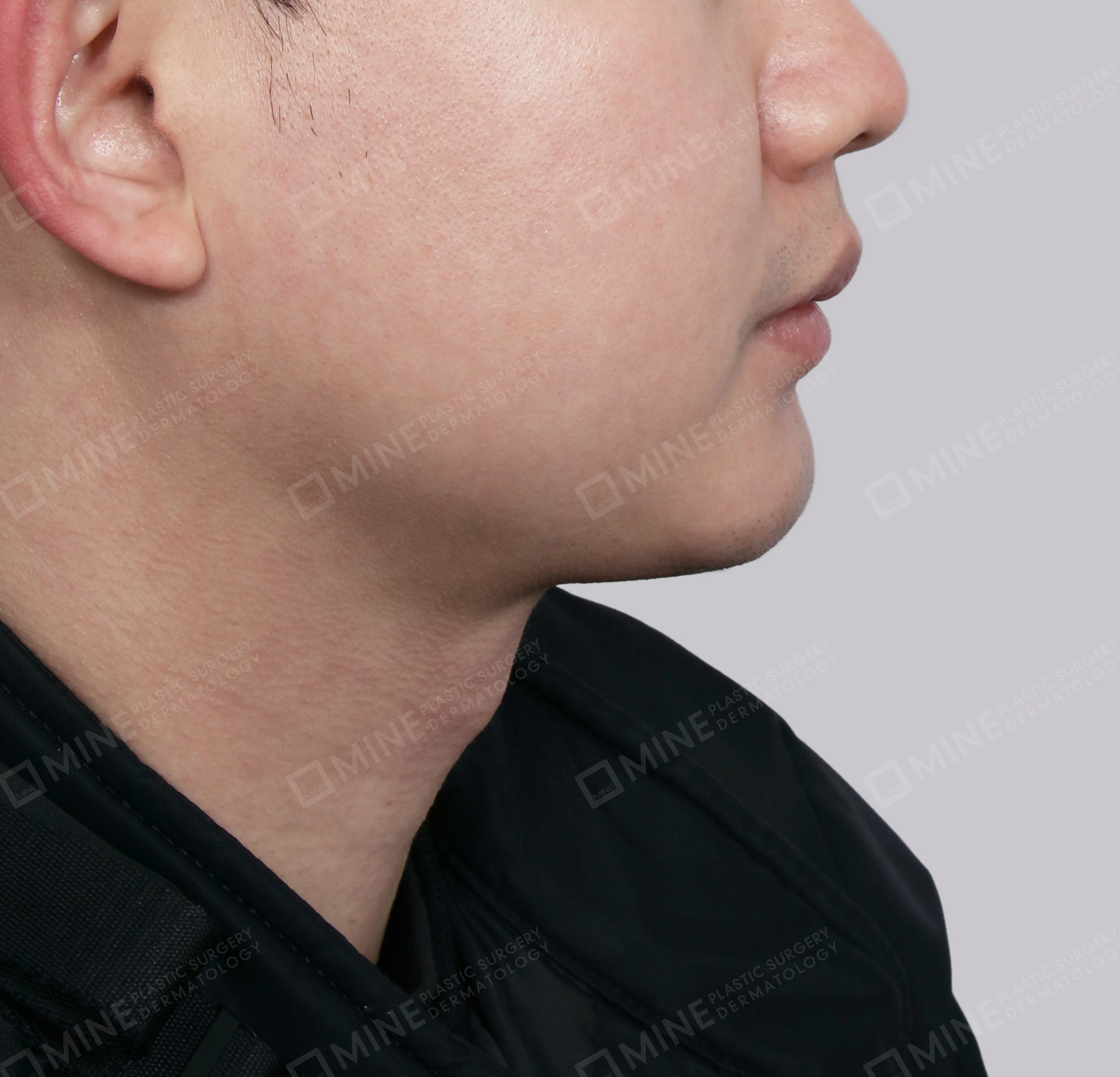 Double Chin (Vlimming)-Side-After