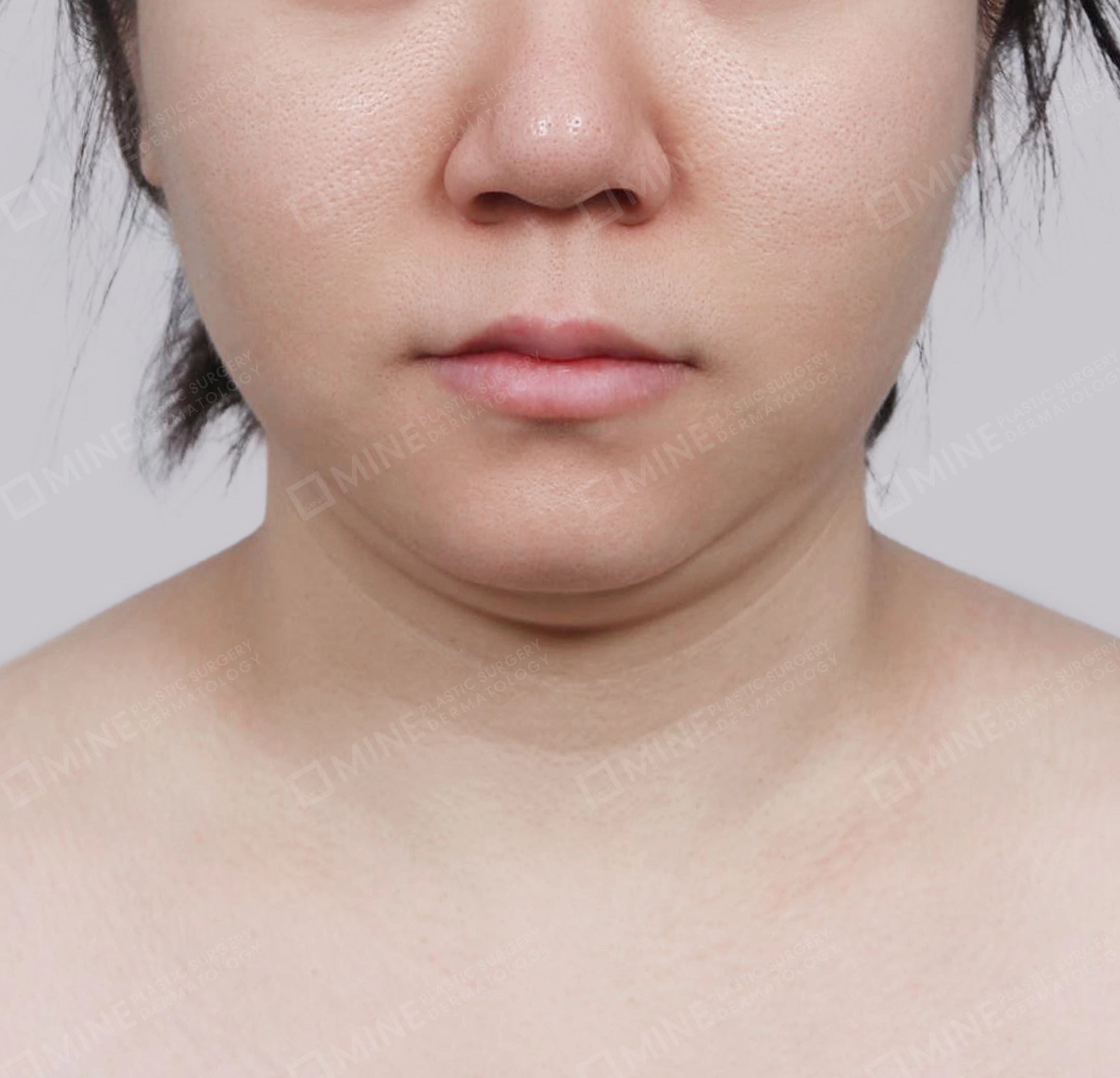 Double Chin (Vlimming)-정면-전