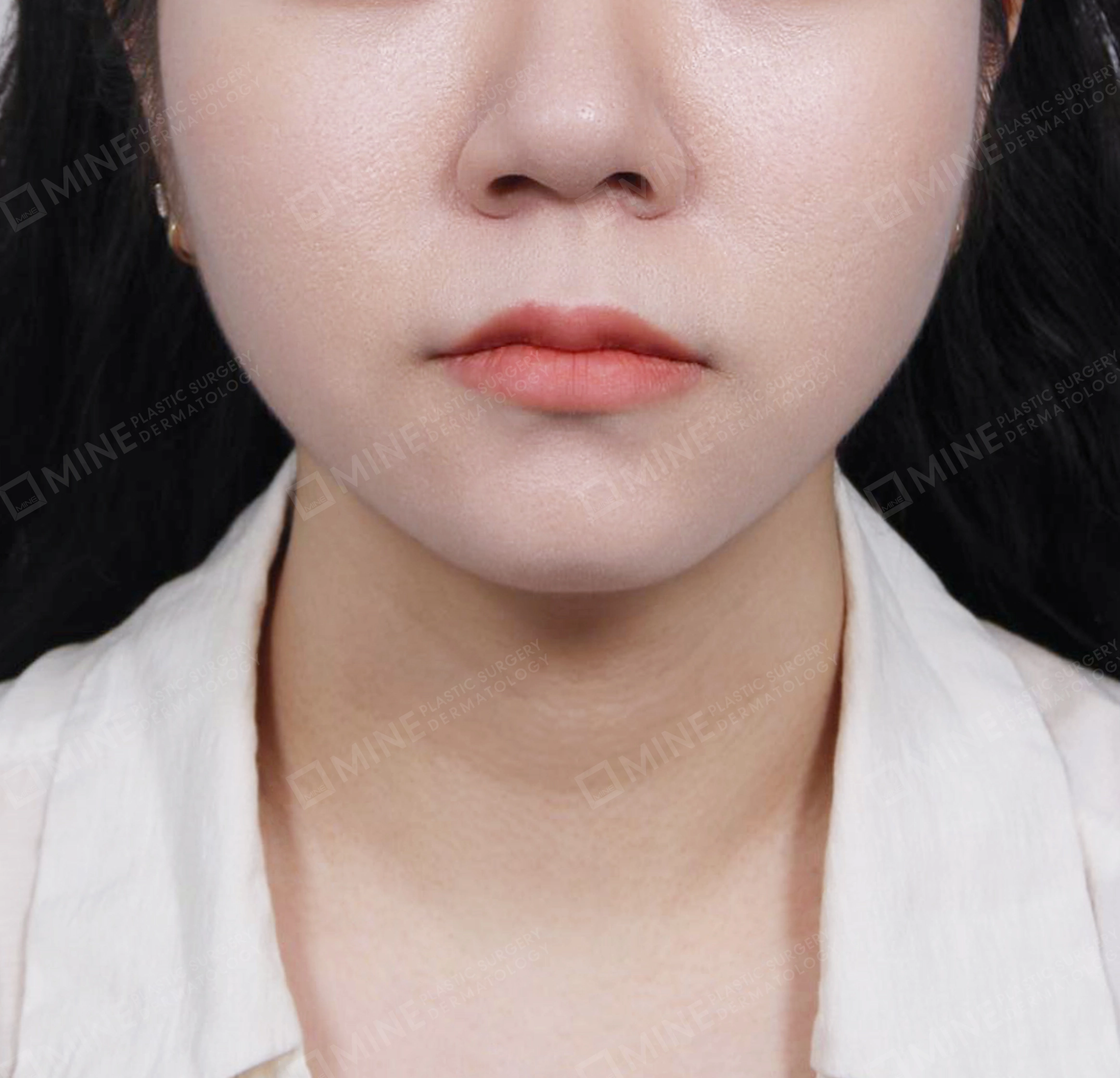 Double Chin (Vlimming)-정면-후