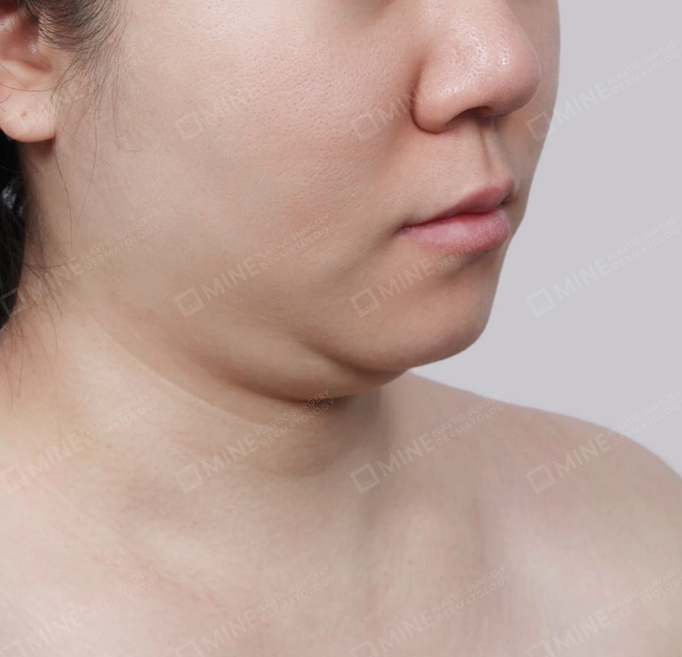 Double Chin (Vlimming)-45도-전