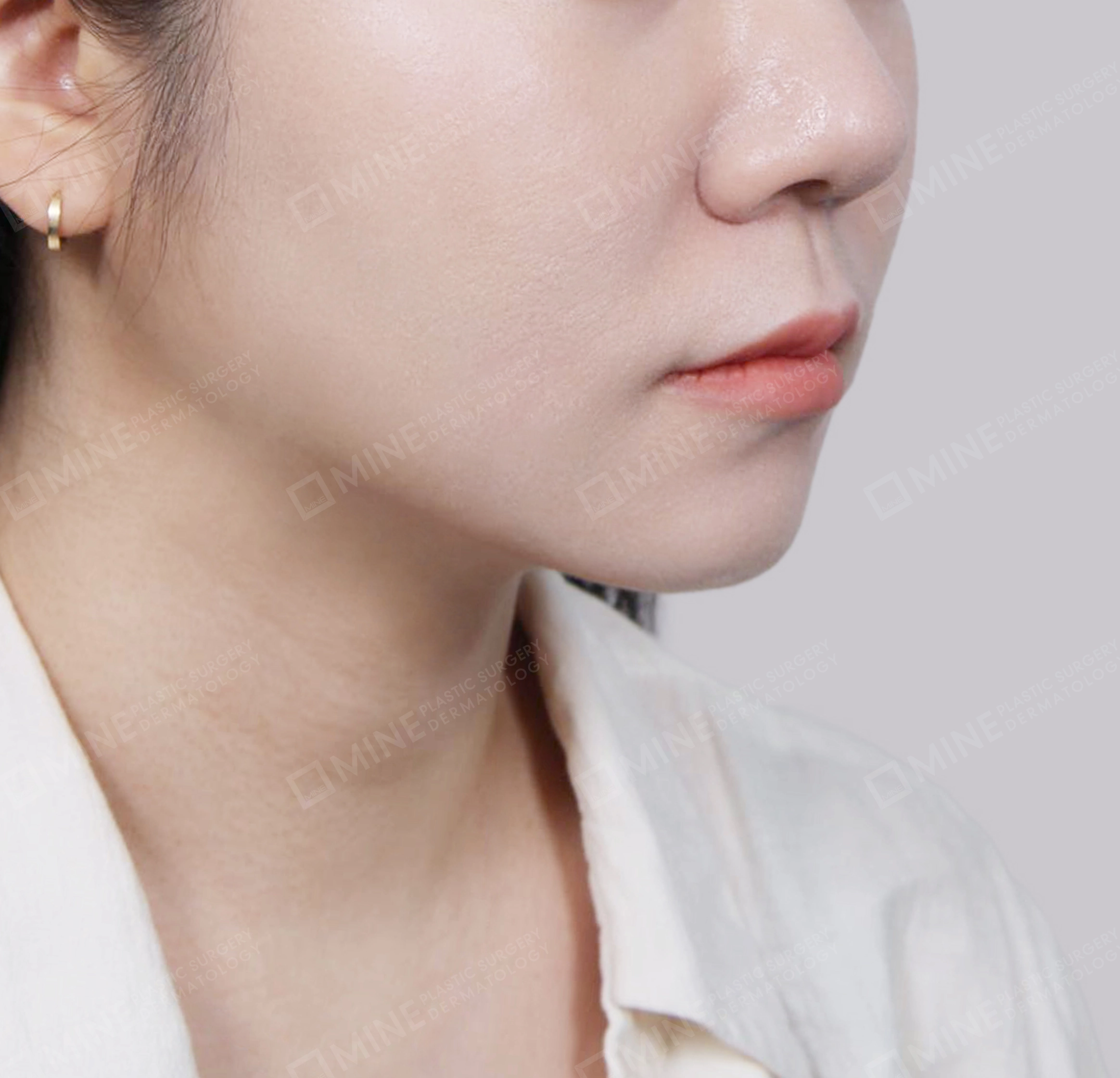 Double Chin (Vlimming)-45도-후