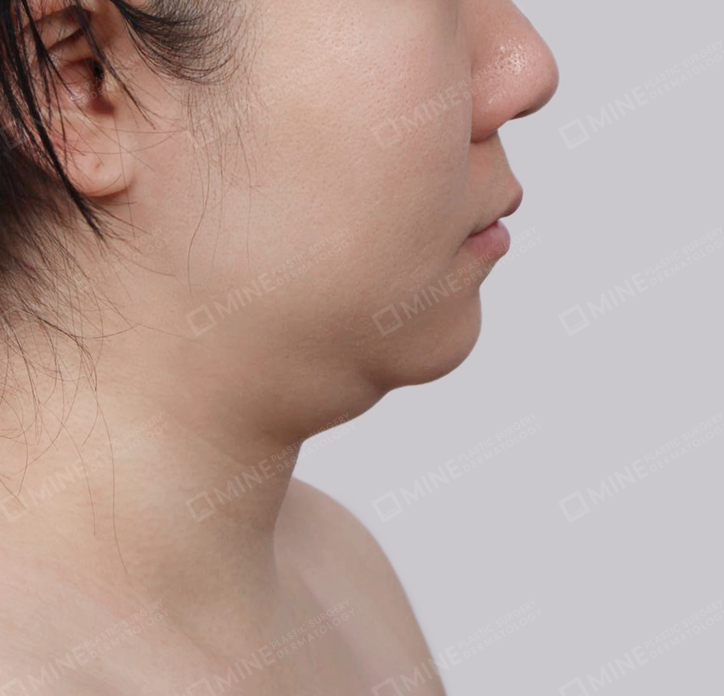 Double Chin (Vlimming)-측면-전