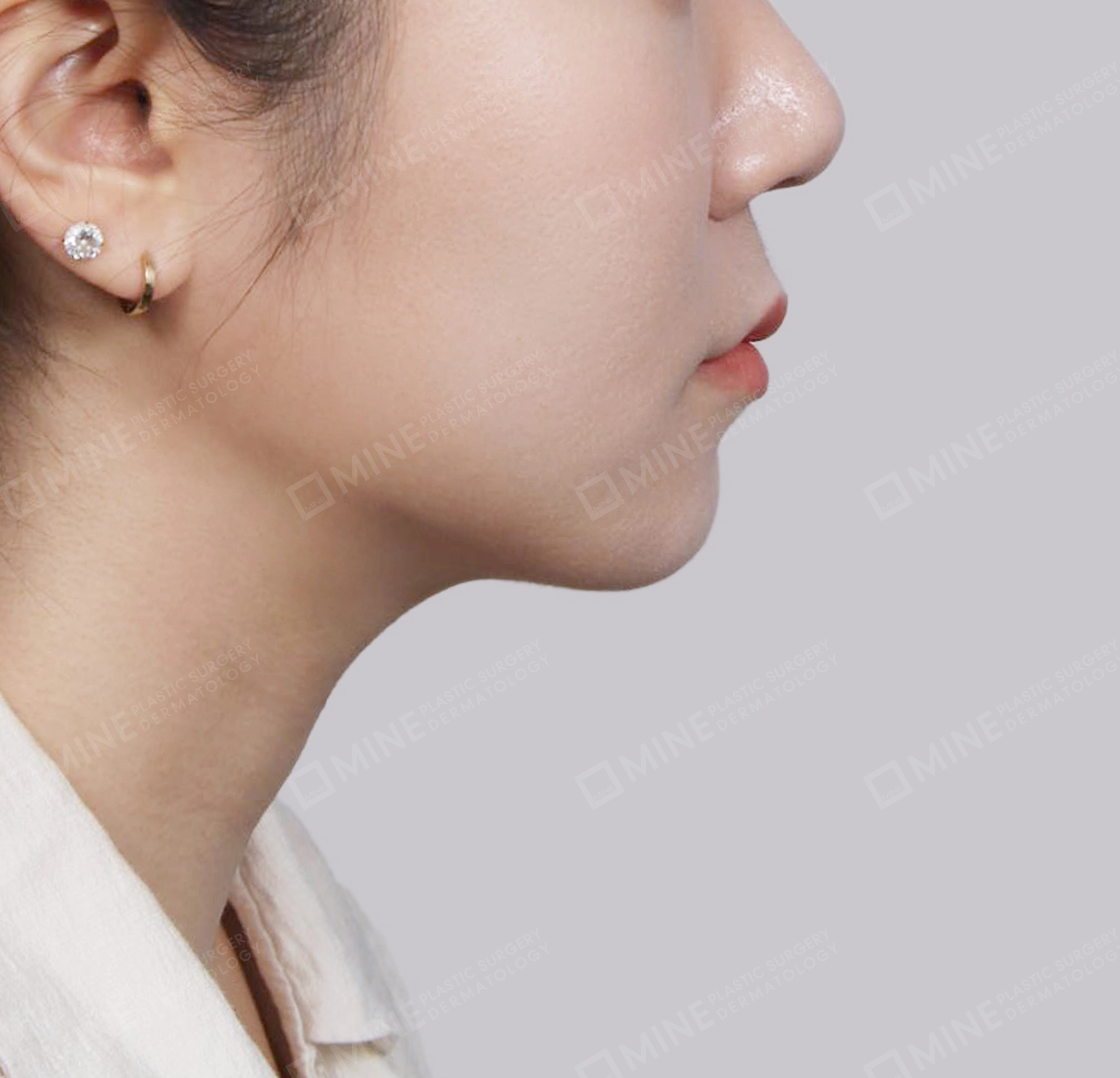 Double Chin (Vlimming)-측면-후