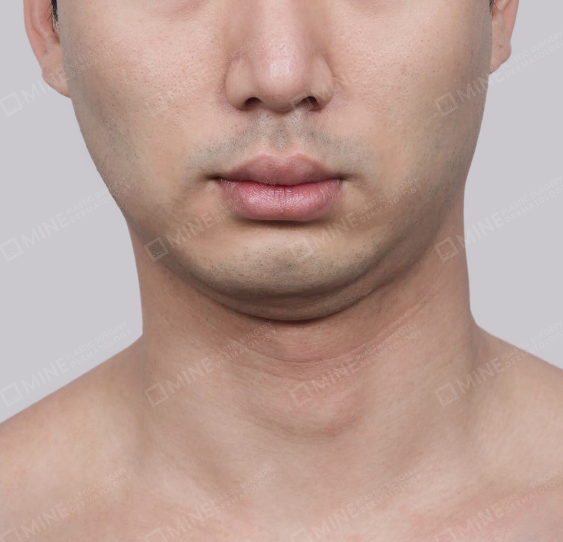 Double Chin (Vlimming)-정면-전