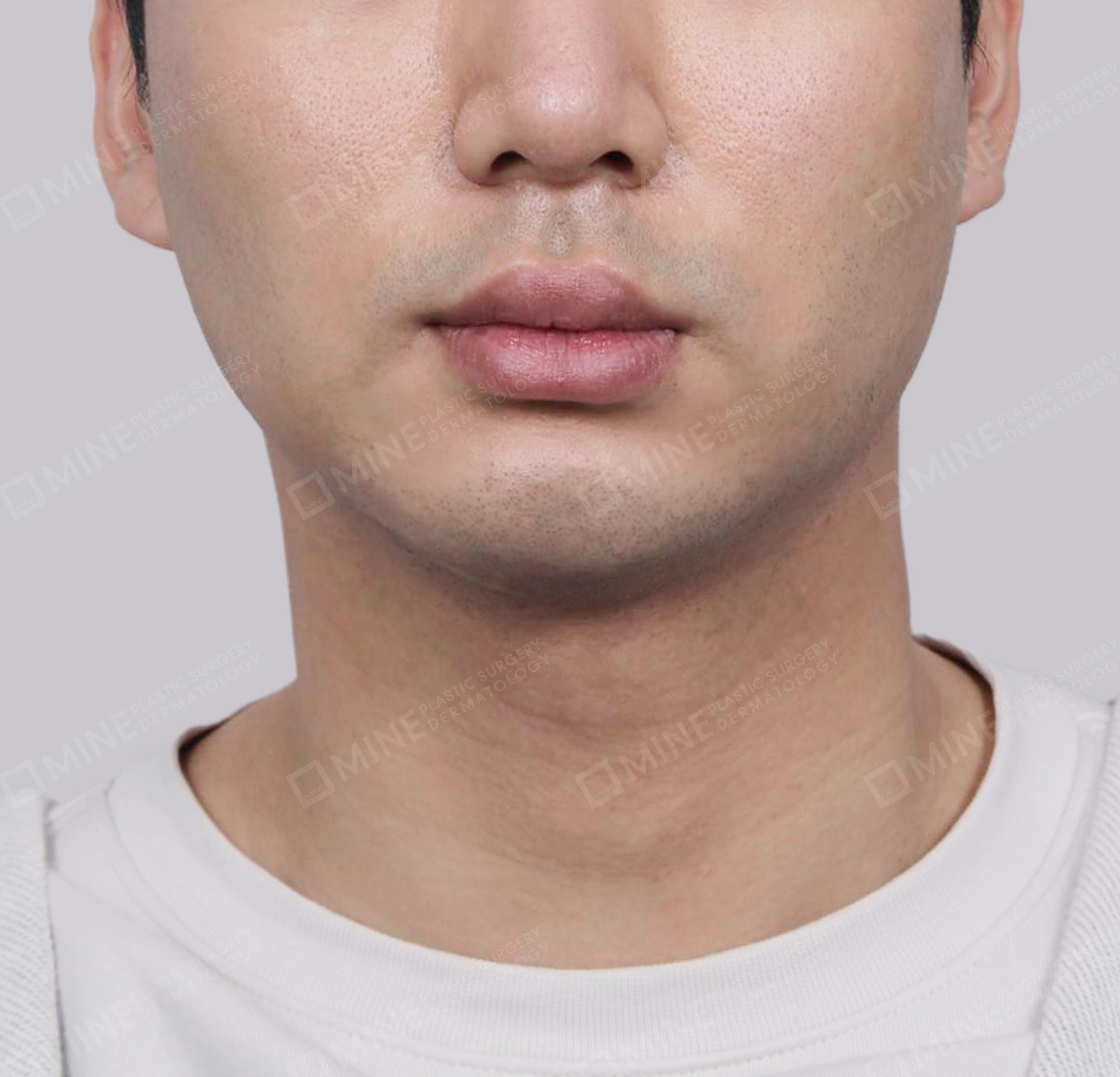 Double Chin (Vlimming)-정면-후