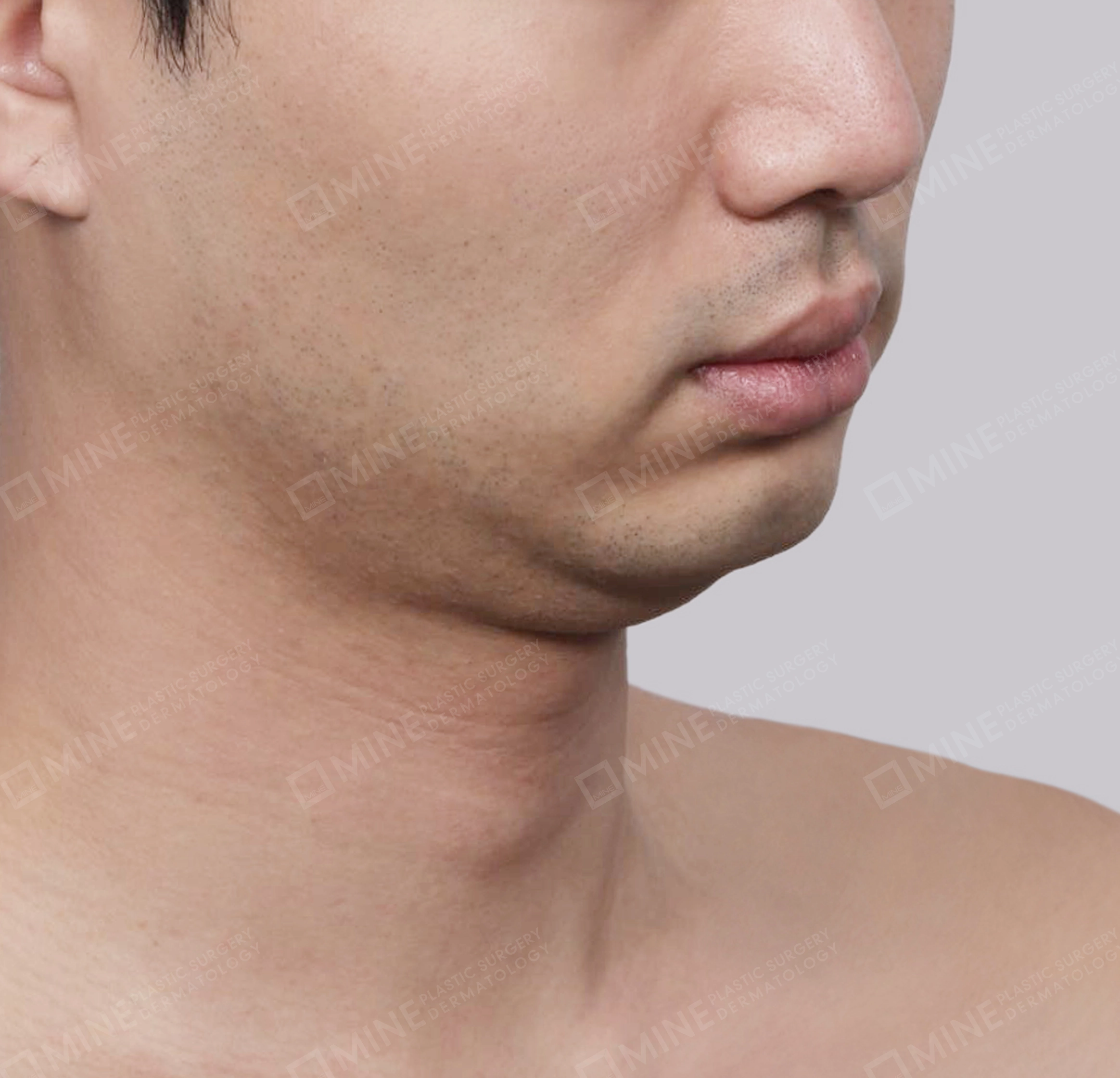 Double Chin (Vlimming)-45도-전