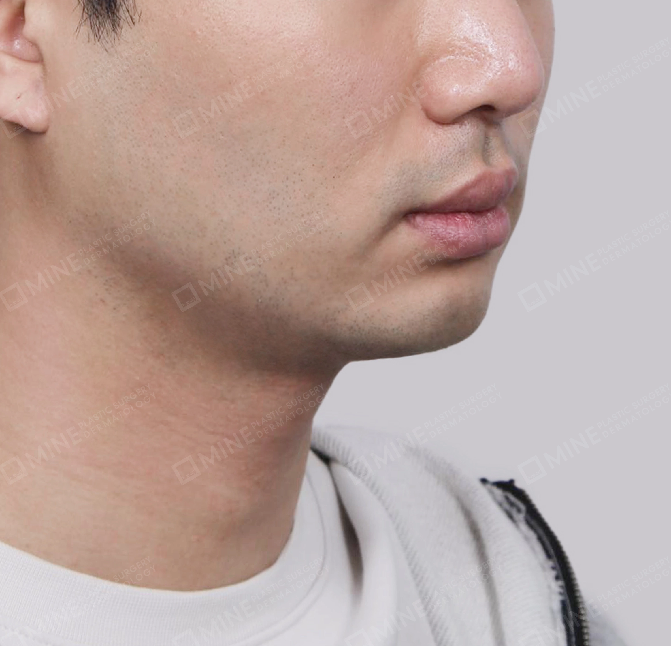 Double Chin (Vlimming)-45도-후