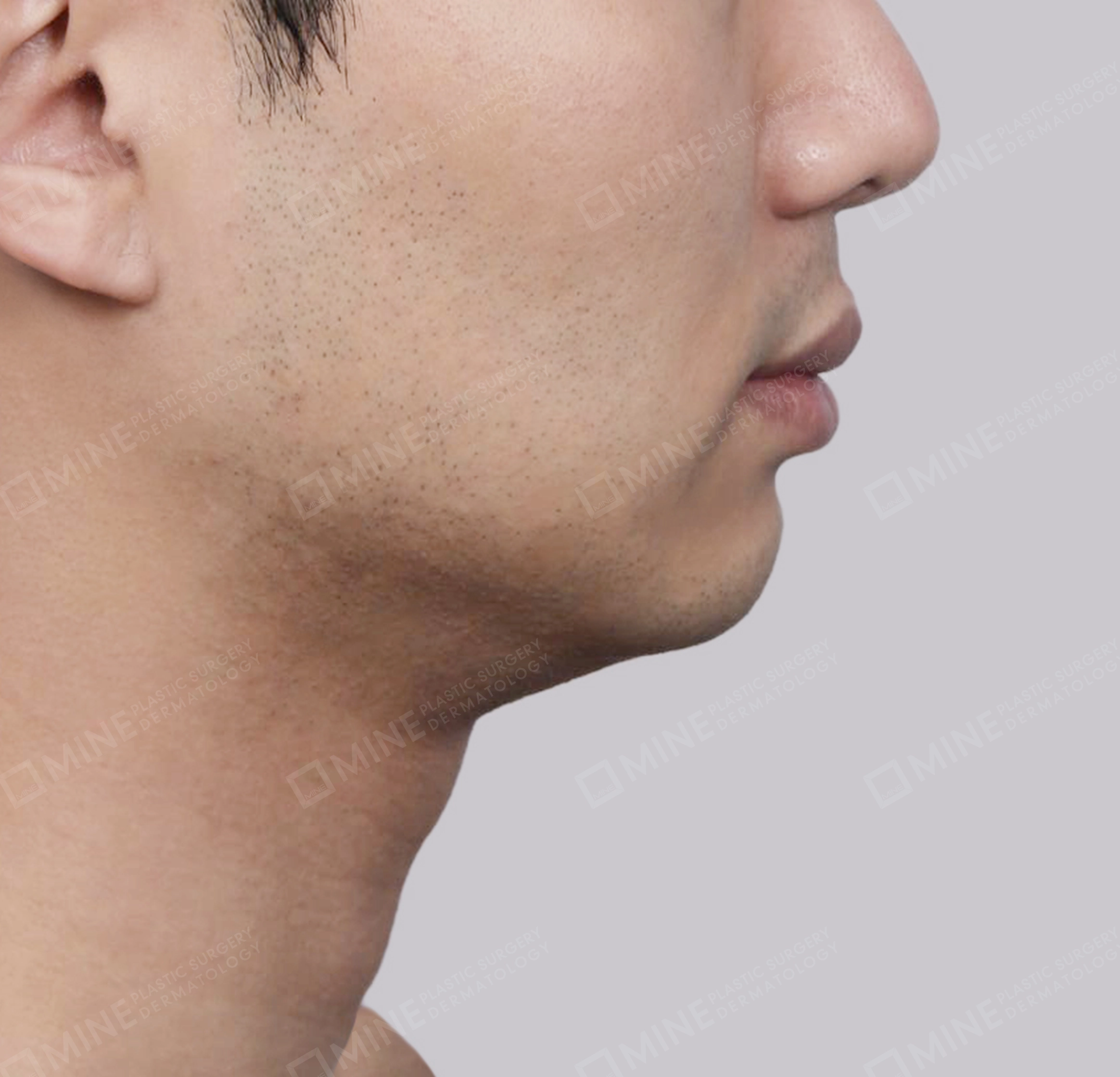 Double Chin (Vlimming)-측면-전