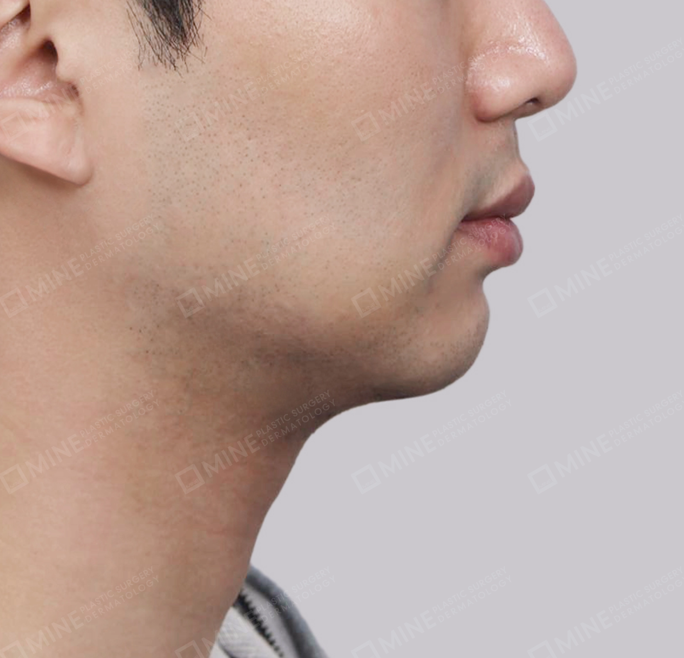 Double Chin (Vlimming)-측면-후