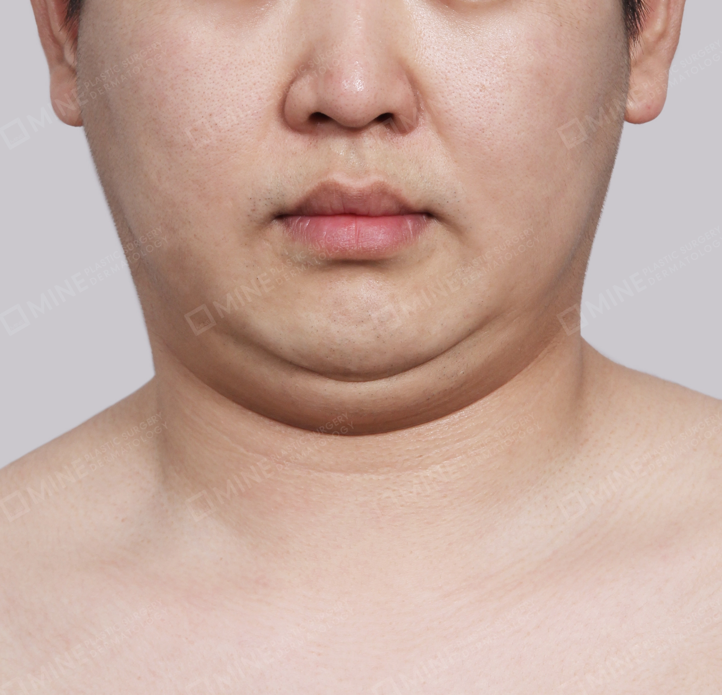 Double Chin (Vlimming)-정면-전