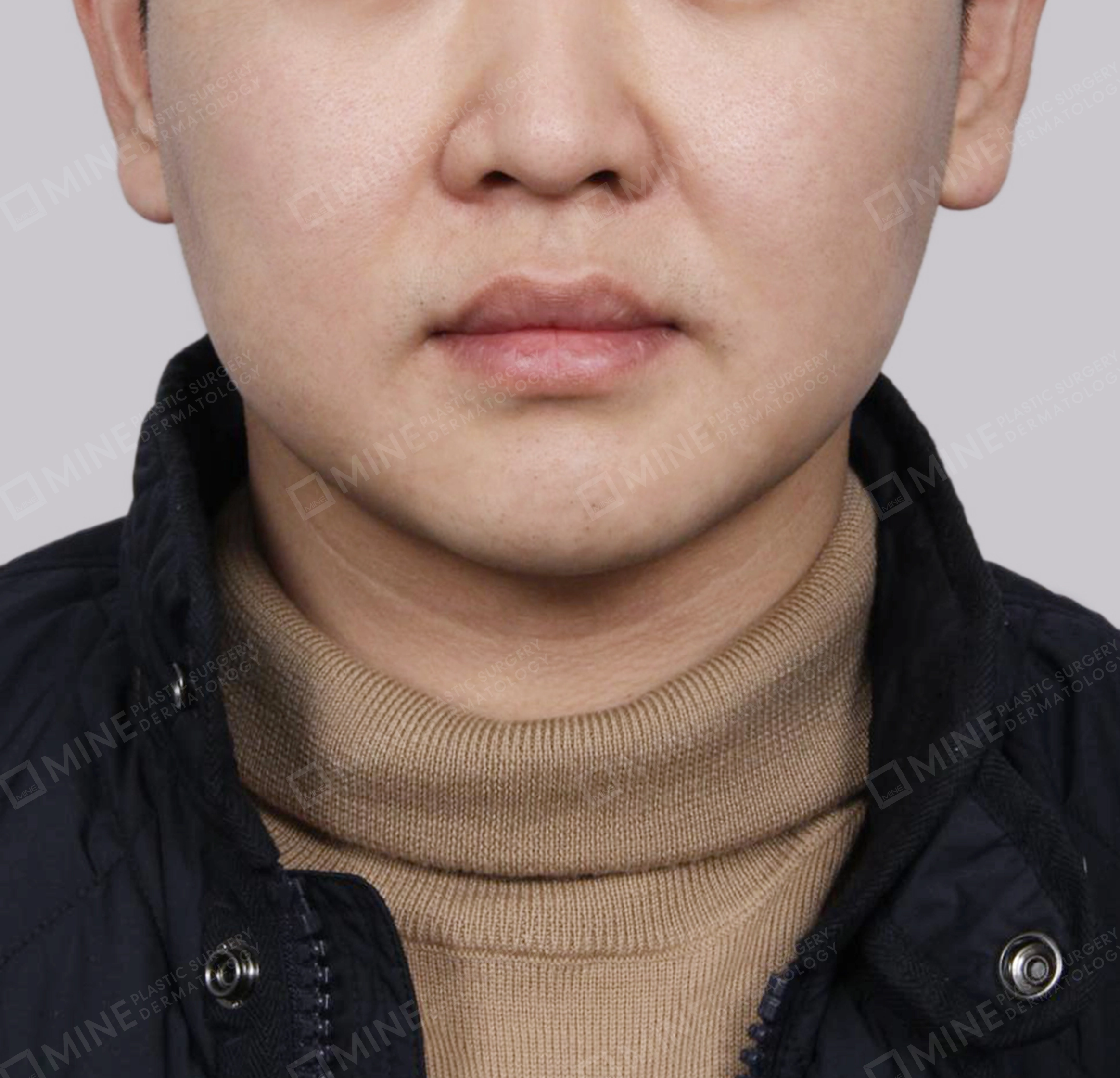 Double Chin (Vlimming)-정면-후