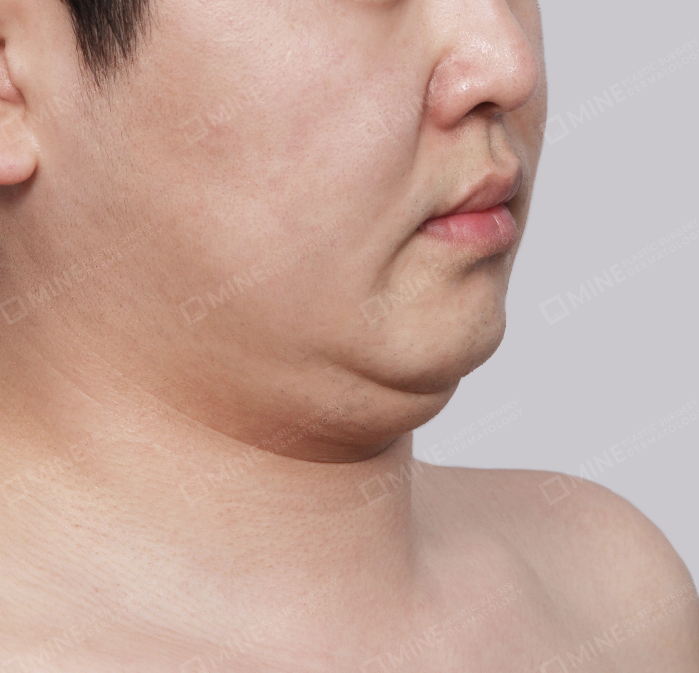 Double Chin (Vlimming)-45도-전