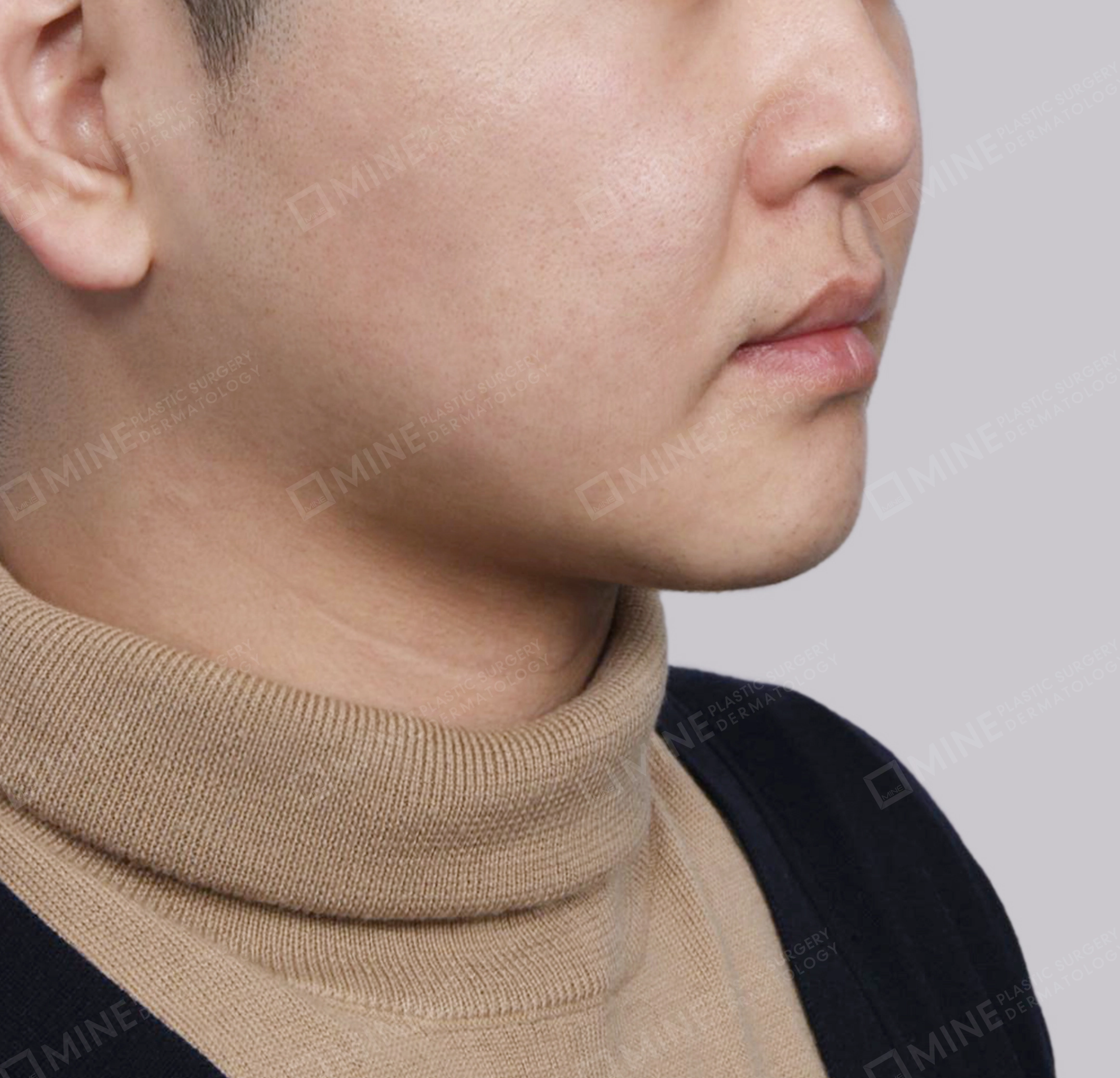 Double Chin (Vlimming)-45도-후
